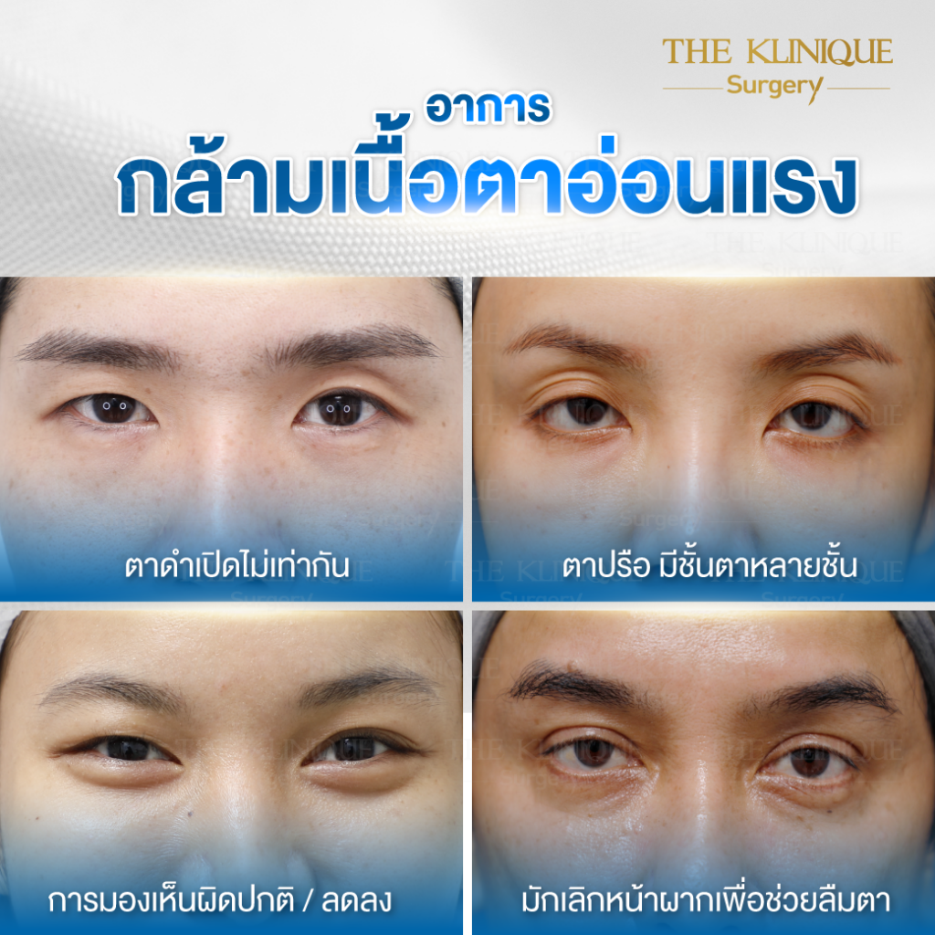 Foxy Eyes, ศัลยกรรมตา, ตาสองชั้น, คลินิกทำตา, ทำตาสองชั้น. ทำตา2ชั้น, กล้ามเนื้อตาอ่อนแรง, แก้ตา, แก้หนังตาตก,หางตาตก, ตาตก,ยกหางตา, แก้ตา, แก้ตาสองชั้น, แก้หนังตาตก , แก้ตาไม่เท่ากัน ,หนังตาตก,แก้หนังตาตก