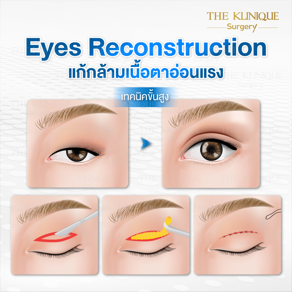 Foxy Eyes, ศัลยกรรมตา, ตาสองชั้น, คลินิกทำตา, ทำตาสองชั้น. ทำตา2ชั้น, กล้ามเนื้อตาอ่อนแรง, แก้ตา, แก้หนังตาตก,หางตาตก, ตาตก,ยกหางตา, แก้ตา, แก้ตาสองชั้น, แก้หนังตาตก , แก้ตาไม่เท่ากัน ,หนังตาตก,แก้หนังตาตก