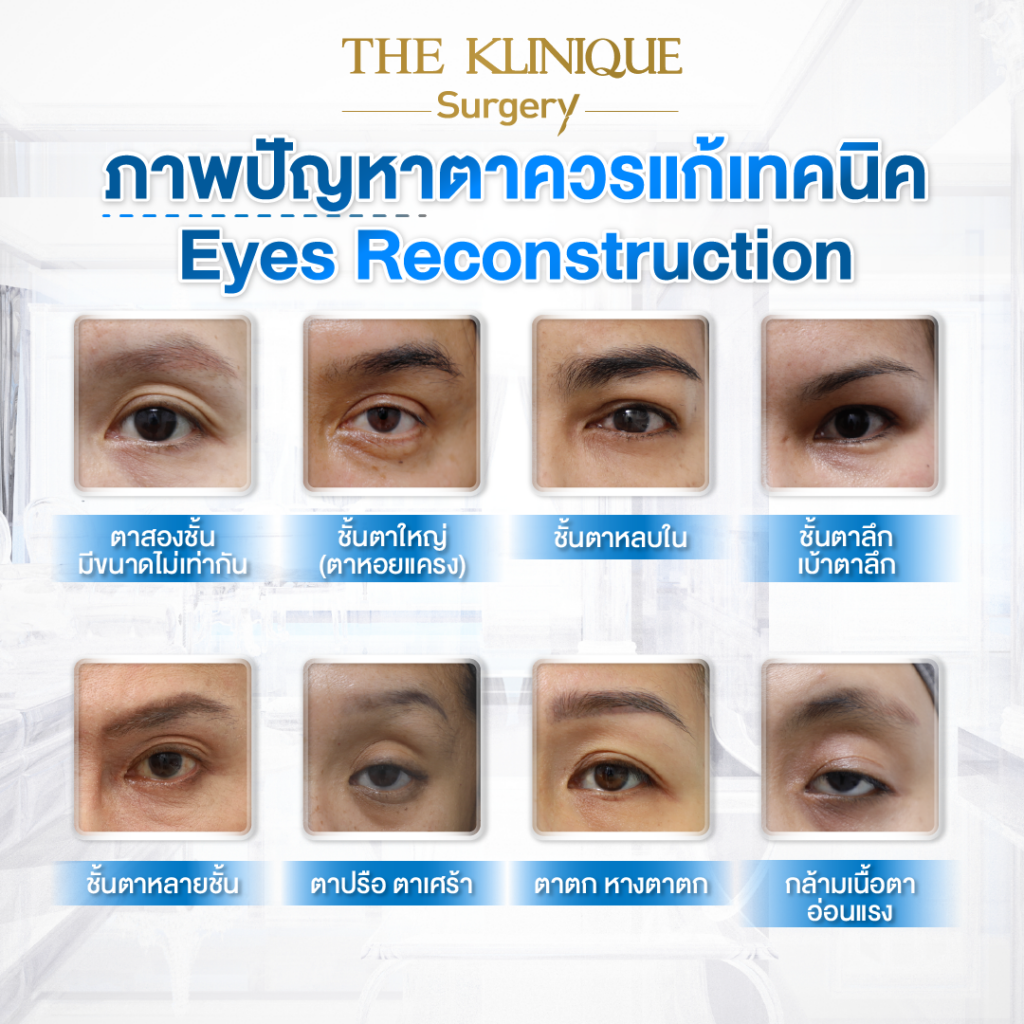 Foxy Eyes, ศัลยกรรมตา, ตาสองชั้น, คลินิกทำตา, ทำตาสองชั้น. ทำตา2ชั้น, กล้ามเนื้อตาอ่อนแรง, แก้ตา, แก้หนังตาตก,หางตาตก, ตาตก,ยกหางตา, แก้ตา, แก้ตาสองชั้น, แก้หนังตาตก , แก้ตาไม่เท่ากัน ,หนังตาตก,แก้หนังตาตก