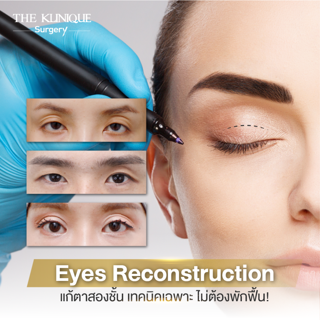 Foxy Eyes, ศัลยกรรมตา, ตาสองชั้น, คลินิกทำตา, ทำตาสองชั้น. ทำตา2ชั้น, กล้ามเนื้อตาอ่อนแรง, แก้ตา, แก้หนังตาตก,หางตาตก, ตาตก,ยกหางตา, แก้ตา, แก้ตาสองชั้น, แก้หนังตาตก , แก้ตาไม่เท่ากัน ,หนังตาตก,แก้หนังตาตก