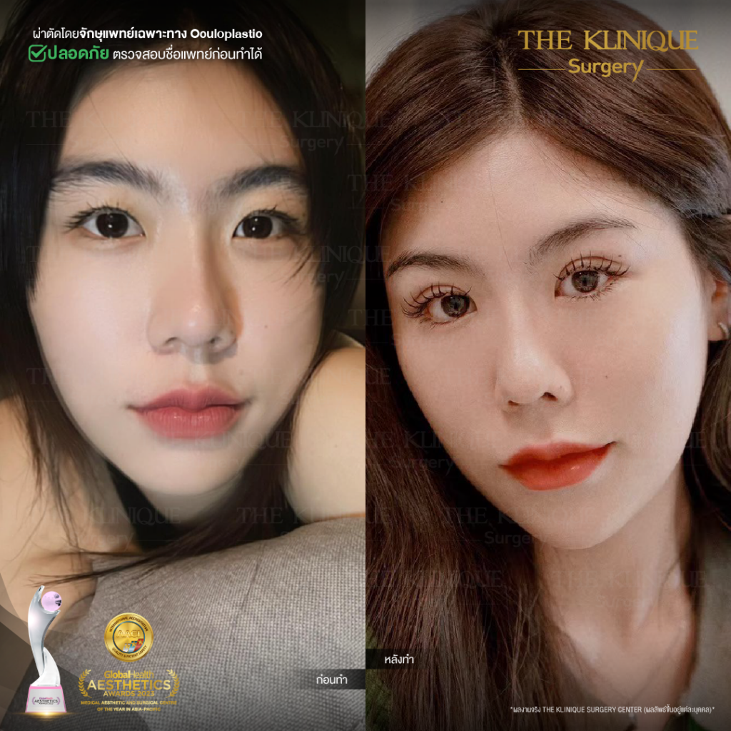 Foxy Eyes, ศัลยกรรมตา, ตาสองชั้น, คลินิกทำตา, ทำตาสองชั้น. ทำตา2ชั้น, กล้ามเนื้อตาอ่อนแรง, แก้ตา, แก้หนังตาตก,หางตาตก, ตาตก,ยกหางตา, แก้ตา, แก้ตาสองชั้น, แก้หนังตาตก , แก้ตาไม่เท่ากัน ,หนังตาตก,แก้หนังตาตก