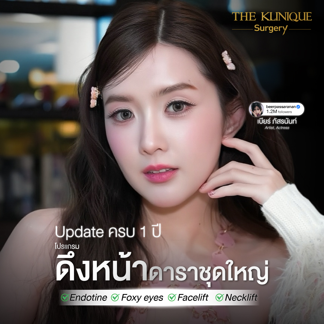 ดึงหน้า, ศัลยกรรมดึงหน้า,ดึงหน้าย้อนวัย, ดึงหน้าที่ไหนดี, ผ่าตัดดึงหน้า, ยกคิ้ว, ยกหางตา, ดึงหน้าดารา, ดึงหน้ารีวิว, Facelift, Endotine, ยกคิ้ว Endotine,ยกคิ้ว รีวิว, ยกคิ้วส่องกล้อง, ยกคิ้วที่ไหนดี,ศัลยกรรมยกคิ้ว