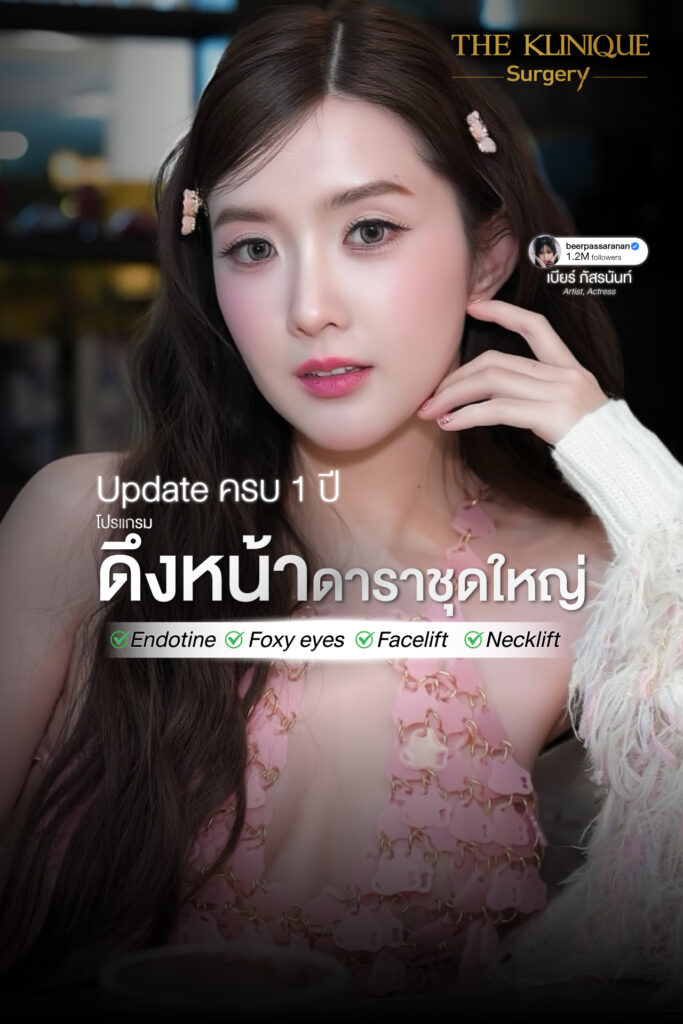 ดึงหน้า, ศัลยกรรมดึงหน้า,ดึงหน้าย้อนวัย, ดึงหน้าที่ไหนดี, ผ่าตัดดึงหน้า, ยกคิ้ว, ยกหางตา, ดึงหน้าดารา, ดึงหน้ารีวิว, Facelift, Endotine, ยกคิ้ว Endotine,ยกคิ้ว รีวิว, ยกคิ้วส่องกล้อง, ยกคิ้วที่ไหนดี,ศัลยกรรมยกคิ้ว