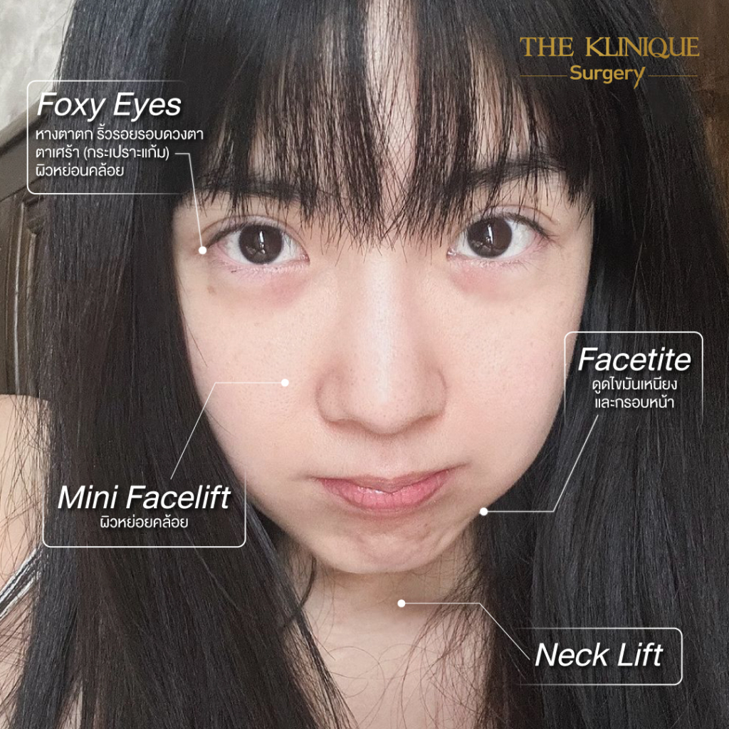 ดูดไขมันเหนียง, ดึงหน้า, ศัลยกรรมดึงหน้า,ดึงหน้าย้อนวัย, ดึงหน้าที่ไหนดี, ผ่าตัดดึงหน้า, ยกคิ้ว, ยกหางตา, หางตาตก, ดึงหน้าดารา, ดึงหน้ารีวิว, Facelift, Neck lift, Endotine, ยกคิ้ว Endotine,Foxy Eyes, แก้หนังตาตก , แก้ตาไม่เท่ากัน ,หนังตาตก,แก้หนังตาตก,ยกคิ้ว รีวิว, ยกคิ้วส่องกล้อง, ยกคิ้วที่ไหนดี, ยกคิ้ว,ศัลยกรรมยกคิ้ว