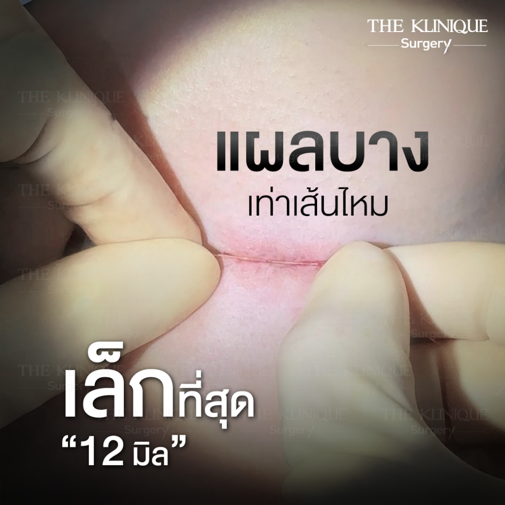 
เสริมหน้าอก, ศัลยกรรมหน้าอก, เสริมหน้าอกที่ไหนดี, แก้หน้าอก, แก้หน้าอกที่ไหนดี, เสริมหน้าอกราคา, แก้หน้าอก ราคา, รีวิวแก้หน้าอก, รีวิวเสริมหน้าอก, แก้หน้าอกไม่เท่ากัน, ทำหน้าอก, ทำนม, ซิลิโคนหน้าอก