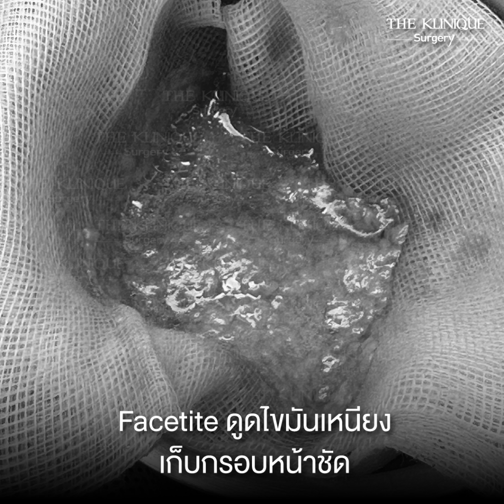 ดูดไขมันเหนียง, ดึงหน้า, ศัลยกรรมดึงหน้า,ดึงหน้าย้อนวัย, ดึงหน้าที่ไหนดี, ผ่าตัดดึงหน้า, ยกคิ้ว, ยกหางตา, หางตาตก, ดึงหน้าดารา, ดึงหน้ารีวิว, Facelift, Neck lift, Endotine, ยกคิ้ว Endotine,Foxy Eyes, แก้หนังตาตก , แก้ตาไม่เท่ากัน ,หนังตาตก,แก้หนังตาตก,ยกคิ้ว รีวิว, ยกคิ้วส่องกล้อง, ยกคิ้วที่ไหนดี, ยกคิ้ว,ศัลยกรรมยกคิ้ว