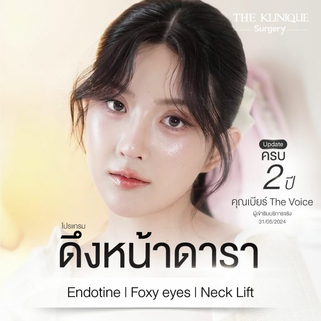 ดึงหน้า, ศัลยกรรมดึงหน้า,ดึงหน้าย้อนวัย, ดึงหน้าที่ไหนดี, ผ่าตัดดึงหน้า, ยกคิ้ว, ยกหางตา, ดึงหน้าดารา, ดึงหน้ารีวิว, Facelift, Endotine, ยกคิ้ว Endotine,ยกคิ้ว รีวิว, ยกคิ้วส่องกล้อง, ยกคิ้วที่ไหนดี,ศัลยกรรมยกคิ้ว