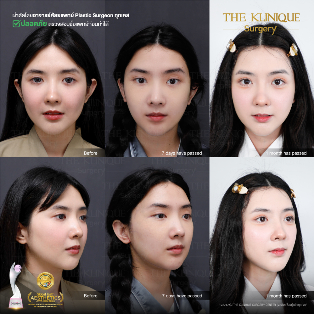ดูดไขมันเหนียง, ดึงหน้า, ศัลยกรรมดึงหน้า,ดึงหน้าย้อนวัย, ดึงหน้าที่ไหนดี, ผ่าตัดดึงหน้า, ยกคิ้ว, ยกหางตา, หางตาตก, ดึงหน้าดารา, ดึงหน้ารีวิว, Facelift, Neck lift, Endotine, ยกคิ้ว Endotine,Foxy Eyes, แก้หนังตาตก , แก้ตาไม่เท่ากัน ,หนังตาตก,แก้หนังตาตก,ยกคิ้ว รีวิว, ยกคิ้วส่องกล้อง, ยกคิ้วที่ไหนดี, ยกคิ้ว,ศัลยกรรมยกคิ้ว