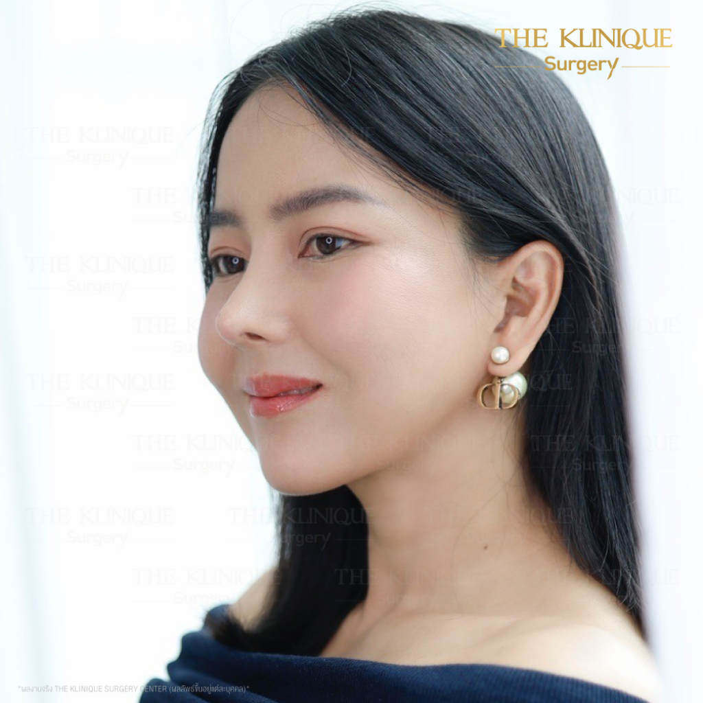 ดึงหน้า, ศัลยกรรมดึงหน้า,ดึงหน้าย้อนวัย, ดึงหน้าที่ไหนดี, ผ่าตัดดึงหน้า, ยกคิ้ว, ยกหางตา, หางตาตก, ดึงหน้าดารา, ดึงหน้ารีวิว, Facelift, Neck lift, Endotine, ยกคิ้ว Endotine,Foxy Eyes, แก้หนังตาตก , แก้ตาไม่เท่ากัน ,หนังตาตก,แก้หนังตาตก,ยกคิ้ว รีวิว, ยกคิ้วส่องกล้อง, ยกคิ้วที่ไหนดี, ยกคิ้ว,ศัลยกรรมยกคิ้ว