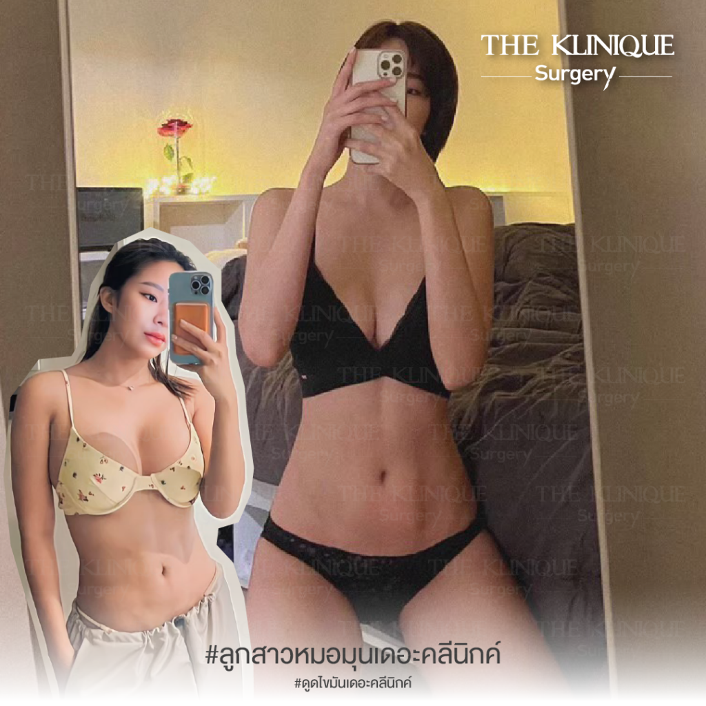 เสริมหน้าอก, ศัลยกรรมหน้าอก, เสริมหน้าอกที่ไหนดี, แก้หน้าอก, แก้หน้าอกที่ไหนดี, เสริมหน้าอกราคา, แก้หน้าอก ราคา, รีวิวแก้หน้าอก, รีวิวเสริมหน้าอก, แก้หน้าอกไม่เท่ากัน, ทำหน้าอก, ทำนม, ซิลิโคนหน้าอก
