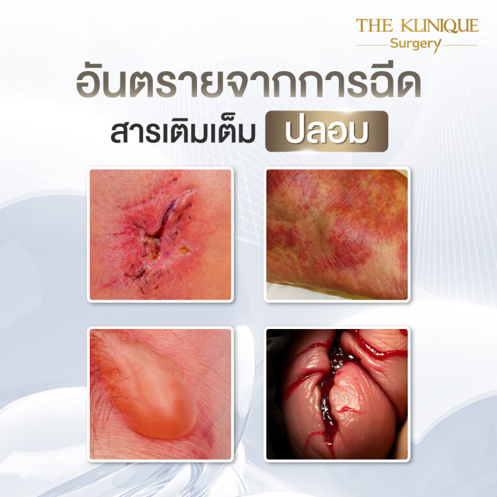ฟิลเลอร์ , ฟิลเลอร์น้องชาย, ปรับขนาดน้องชาย, ปรับขนาดอวัยวะเพศ, เพิ่มขนาดน้องชาย, ขลิบ, ขลิบไร้เลือด, ขลิบไร้เลือกที่ไหนดี