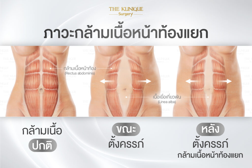Liposuction, Sculpting,Xshape,Lipo, ศัลยกรรมดูดไขมัน, ดูดไขมัน,คลินิกดูดไขมัน,ดูดไขมันเฉพาะส่วน,ดูดไขมันเหนียง,ดูดไขมันหน้าท้อง,ดูดไขมันรีวิว, รีวิวดูดไขมัน, รีวิวดูดไขมันหน้าท้อง,ดูดไขมันต้นแขน, ดูดไขมันต้นขา,ดูดไขมันน่อง, ลดความอ้วน, ดูดไขมันที่ไหนดี, ดูดไขมันราคา, ดูดไขมันทั้งตัว