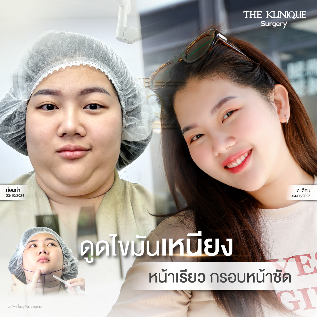 รีวิวดูดไขมันเหนียง