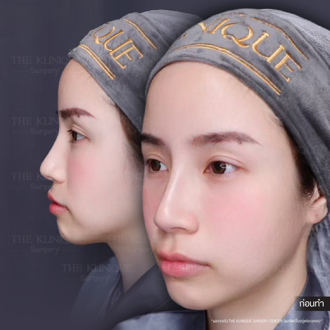 ศัลยกรรมจมูก, เสริมจมูก, เสริมจมูกที่ไหนดี, เสริมจมูกราคา, รีวิว เสริมจมูก, ทำจมูก, ทำจมูก รีวิว,เสริมจมูก Semi Open, เสริมจมูก Open, เสริมจมูก โอเพ่น, ซิลิโคนจมูก, จมูกOpen, รีวิวเสริมจมูกโอเพ่น, รีวิวเสริมจมูก Open, ทรงจมูก, ทรงจมูกสวย, ทรงจมูกเกาหลี, ทรงจมูกธรรมชาติ, ทรงจมูกสันสโลปปลายพุ่ง