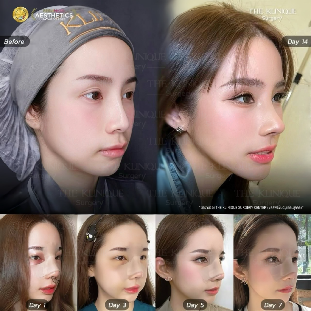 ศัลยกรรมจมูก, เสริมจมูก, เสริมจมูกที่ไหนดี, เสริมจมูกราคา, รีวิว เสริมจมูก, ทำจมูก, ทำจมูก รีวิว,เสริมจมูก Semi Open, เสริมจมูก Open, เสริมจมูก โอเพ่น, ซิลิโคนจมูก, จมูกOpen, รีวิวเสริมจมูกโอเพ่น, รีวิวเสริมจมูก Open, ทรงจมูก, ทรงจมูกสวย, ทรงจมูกเกาหลี, ทรงจมูกธรรมชาติ, ทรงจมูกสันสโลปปลายพุ่ง