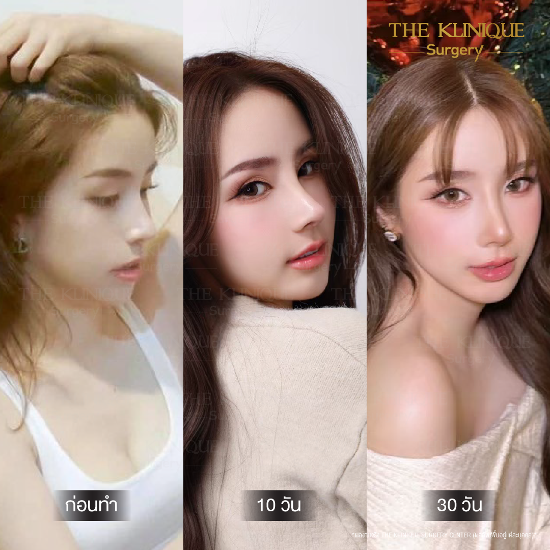 ศัลยกรรมจมูก, เสริมจมูก, เสริมจมูกที่ไหนดี, เสริมจมูกราคา, รีวิว เสริมจมูก, ทำจมูก, ทำจมูก รีวิว,เสริมจมูก Semi Open, เสริมจมูก Open, เสริมจมูก โอเพ่น, ซิลิโคนจมูก, จมูกOpen, รีวิวเสริมจมูกโอเพ่น, รีวิวเสริมจมูก Open, ทรงจมูก, ทรงจมูกสวย, ทรงจมูกเกาหลี, ทรงจมูกธรรมชาติ, ทรงจมูกสันสโลปปลายพุ่ง