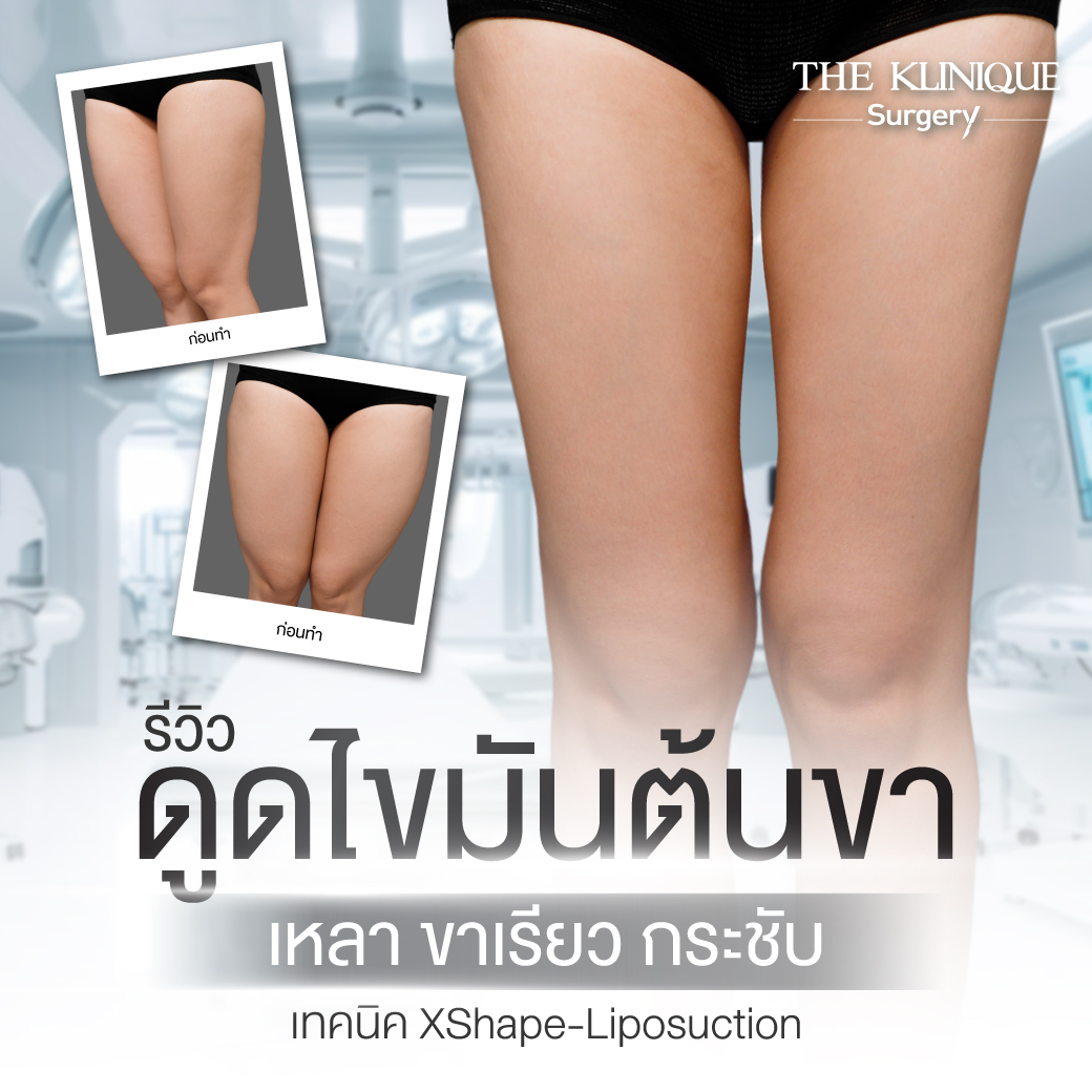 Liposuction, Sculpting,Xshape,Lipo, ศัลยกรรมดูดไขมัน, ดูดไขมัน,คลินิกดูดไขมัน,ดูดไขมันเฉพาะส่วน,ดูดไขมันเหนียง,ดูดไขมันหน้าท้อง,ดูดไขมันรีวิว, รีวิวดูดไขมัน, รีวิวดูดไขมันหน้าท้อง,ดูดไขมันต้นแขน, ดูดไขมันต้นขา,ดูดไขมันน่อง, ลดความอ้วน, ดูดไขมันที่ไหนดี, ดูดไขมันราคา, ดูดไขมันทั้งตัว, รีวิว ดูดไขมันต้นขา, ดูดไขมันขา