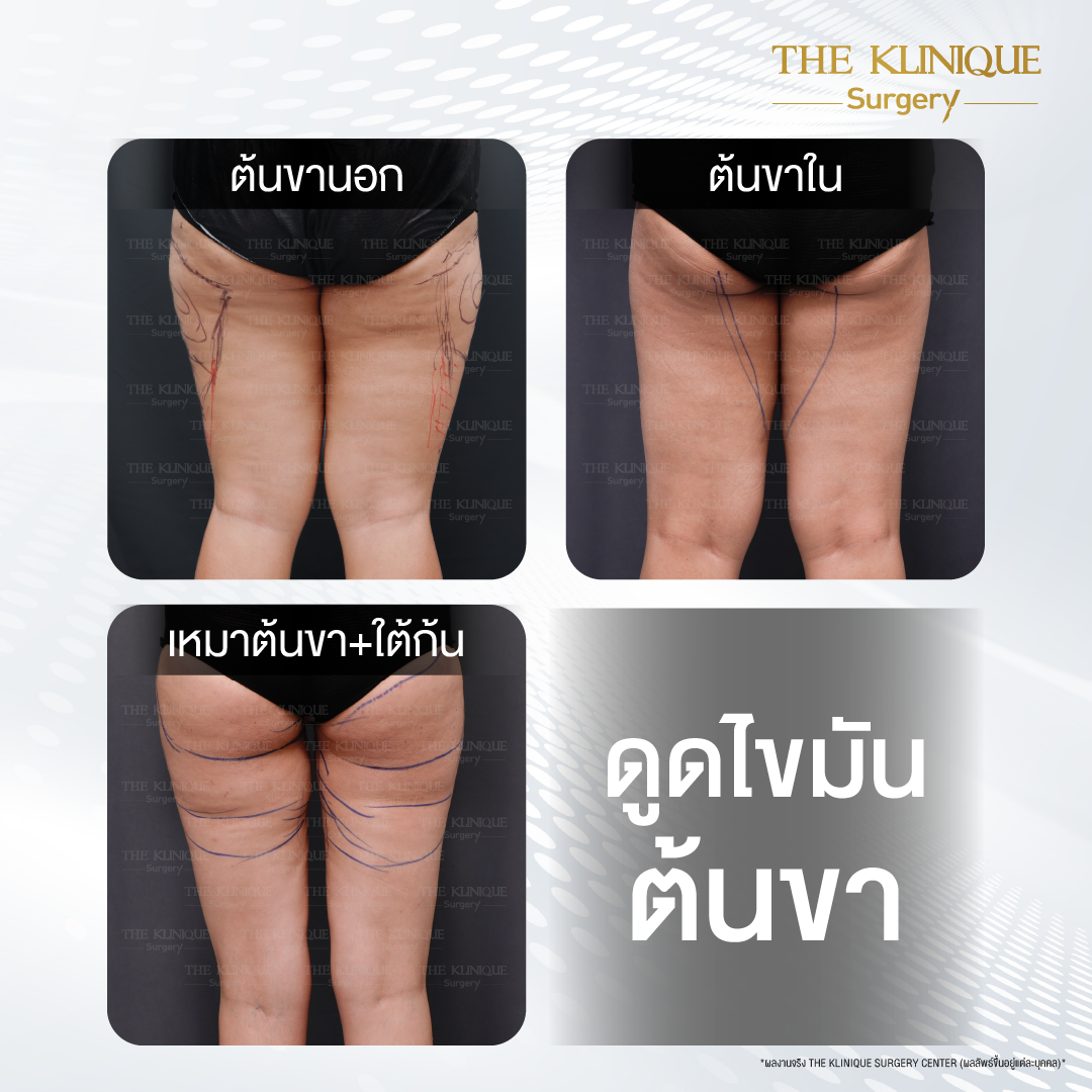 Liposuction, Sculpting,Xshape,Lipo, ศัลยกรรมดูดไขมัน, ดูดไขมัน,คลินิกดูดไขมัน,ดูดไขมันเฉพาะส่วน,ดูดไขมันเหนียง,ดูดไขมันหน้าท้อง,ดูดไขมันรีวิว, รีวิวดูดไขมัน, รีวิวดูดไขมันหน้าท้อง,ดูดไขมันต้นแขน, ดูดไขมันต้นขา,ดูดไขมันน่อง, ลดความอ้วน, ดูดไขมันที่ไหนดี, ดูดไขมันราคา, ดูดไขมันทั้งตัว, รีวิว ดูดไขมันต้นขา, ดูดไขมันขา