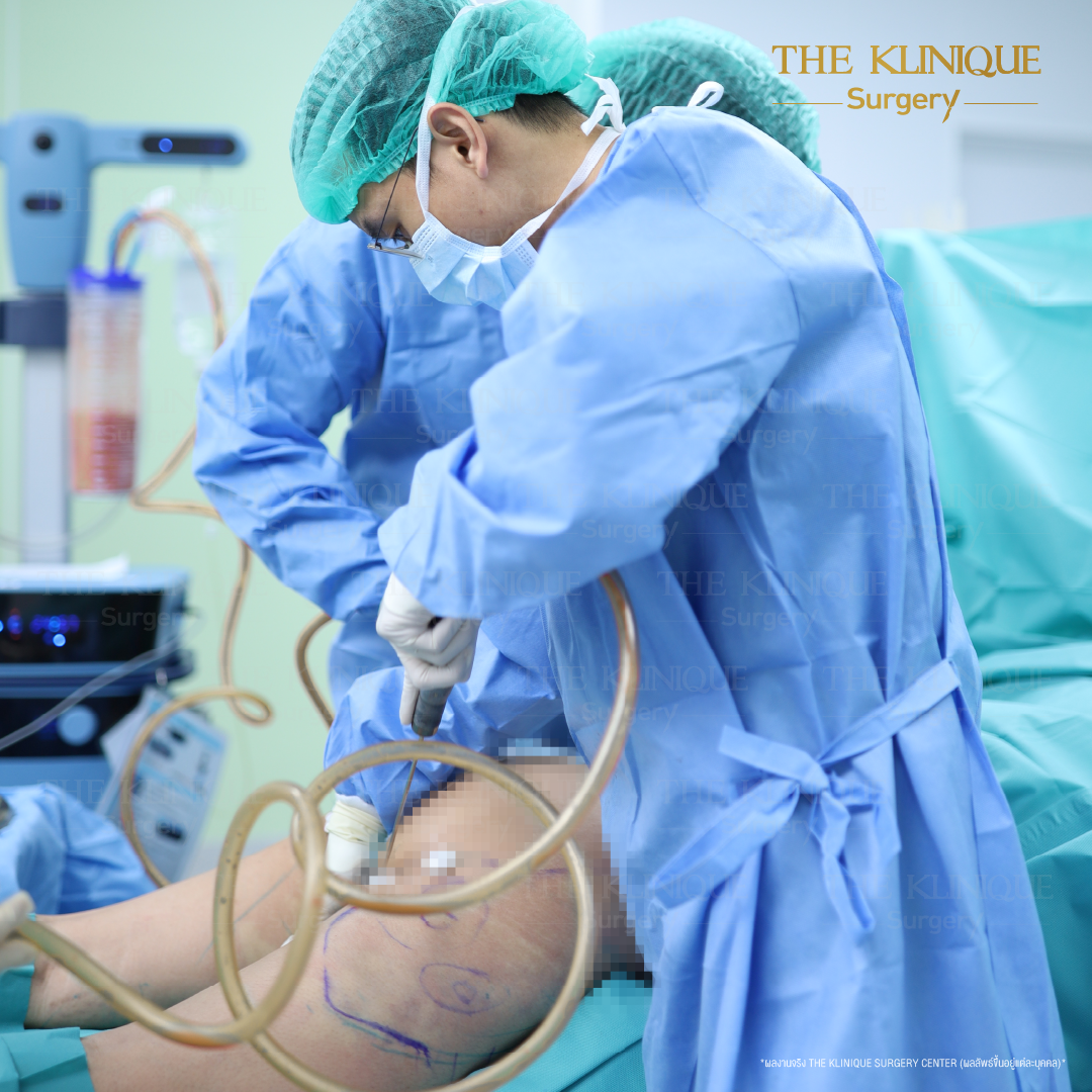 Liposuction, Sculpting,Xshape,Lipo, ศัลยกรรมดูดไขมัน, ดูดไขมัน,คลินิกดูดไขมัน,ดูดไขมันเฉพาะส่วน,ดูดไขมันเหนียง,ดูดไขมันหน้าท้อง,ดูดไขมันรีวิว, รีวิวดูดไขมัน, รีวิวดูดไขมันหน้าท้อง,ดูดไขมันต้นแขน, ดูดไขมันต้นขา,ดูดไขมันน่อง, ลดความอ้วน, ดูดไขมันที่ไหนดี, ดูดไขมันราคา, ดูดไขมันทั้งตัว, รีวิว ดูดไขมันต้นขา, ดูดไขมันขา