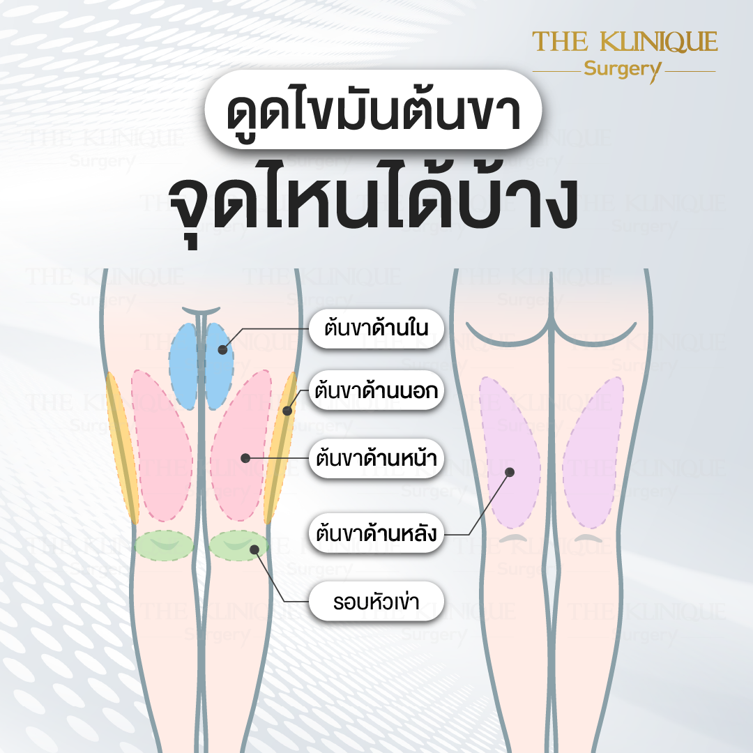 Liposuction, Sculpting,Xshape,Lipo, ศัลยกรรมดูดไขมัน, ดูดไขมัน,คลินิกดูดไขมัน,ดูดไขมันเฉพาะส่วน,ดูดไขมันเหนียง,ดูดไขมันหน้าท้อง,ดูดไขมันรีวิว, รีวิวดูดไขมัน, รีวิวดูดไขมันหน้าท้อง,ดูดไขมันต้นแขน, ดูดไขมันต้นขา,ดูดไขมันน่อง, ลดความอ้วน, ดูดไขมันที่ไหนดี, ดูดไขมันราคา, ดูดไขมันทั้งตัว, รีวิว ดูดไขมันต้นขา, ดูดไขมันขา
