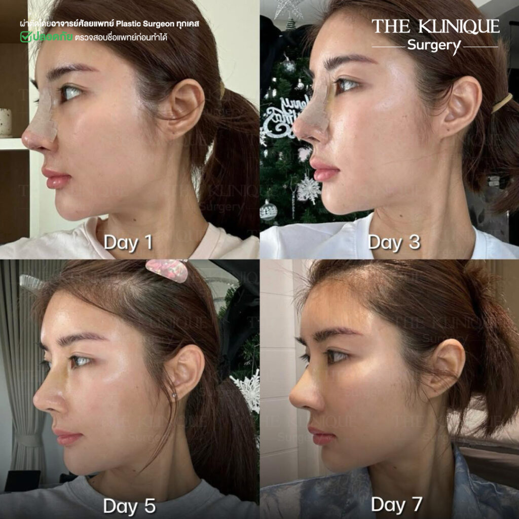 เสริมจมูก, ศัลยกรรมจมูก, ศัลยกรรมจมูก รีวิว, รีวิว เสริมจมูก, ศัลยกรรมจมูกมีกี่แบบ, เสริมจมูกที่ไหนดี, เสริมจมูกโอเพ่น, เสริมจมูกราคา, รีวิวเสริมจมูก, ทำจมูก, ทำจมูก รีวิว, รีวิวทำจมูก, รีวิว ศัลยกรรมจมูก, ซิลิโคนจมูก, แก้จมูก, แก้จมูก รีวิว, รีวิวแก้จมูก, แก้จมูกที่ไหนดี, เสริมจมูก Close, เสริมจมูก semi open, จมูก open, เสริมจมูก Open ที่ไหนดี, รีวิว เสริมจมูก Open, เสริมจมูกโอเพ่น, เสริมจมูกโอเพ่นที่ไหนดี, ทรงจมูก, ทรงจมูกสวย, ทรงจมูกเกาหลี, ทรงจมูกธรรมชาติ, ทรงจมูกสโลปปลายพุ่ง, ทรงจมูกผู้ชาย,จมูก พส. จีน, หน้า พส จีน, พส จีน, V-Line, หน้า V-Line, Endoscopic, ศัลยกรรมคาง, เสริมคาง, เสริมคาง ปรับรูปหน้า, ตัดกราม