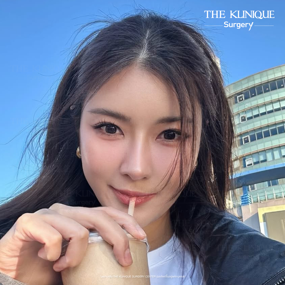 เสริมจมูก, ศัลยกรรมจมูก, ศัลยกรรมจมูก รีวิว, รีวิว เสริมจมูก, ศัลยกรรมจมูกมีกี่แบบ, เสริมจมูกที่ไหนดี, เสริมจมูกโอเพ่น, เสริมจมูกราคา, รีวิวเสริมจมูก, ทำจมูก, ทำจมูก รีวิว, รีวิวทำจมูก, รีวิว ศัลยกรรมจมูก, ซิลิโคนจมูก, แก้จมูก, แก้จมูก รีวิว, รีวิวแก้จมูก, แก้จมูกที่ไหนดี, เสริมจมูก Close, เสริมจมูก semi open, จมูก open, เสริมจมูก Open ที่ไหนดี, รีวิว เสริมจมูก Open, เสริมจมูกโอเพ่น, เสริมจมูกโอเพ่นที่ไหนดี, ทรงจมูก, ทรงจมูกสวย, ทรงจมูกเกาหลี, ทรงจมูกธรรมชาติ, ทรงจมูกสโลปปลายพุ่ง, ทรงจมูกผู้ชาย,จมูก พส. จีน, หน้า พส จีน, พส จีน, V-Line, หน้า V-Line, Endoscopic, ศัลยกรรมคาง, เสริมคาง, เสริมคาง ปรับรูปหน้า, ตัดกราม