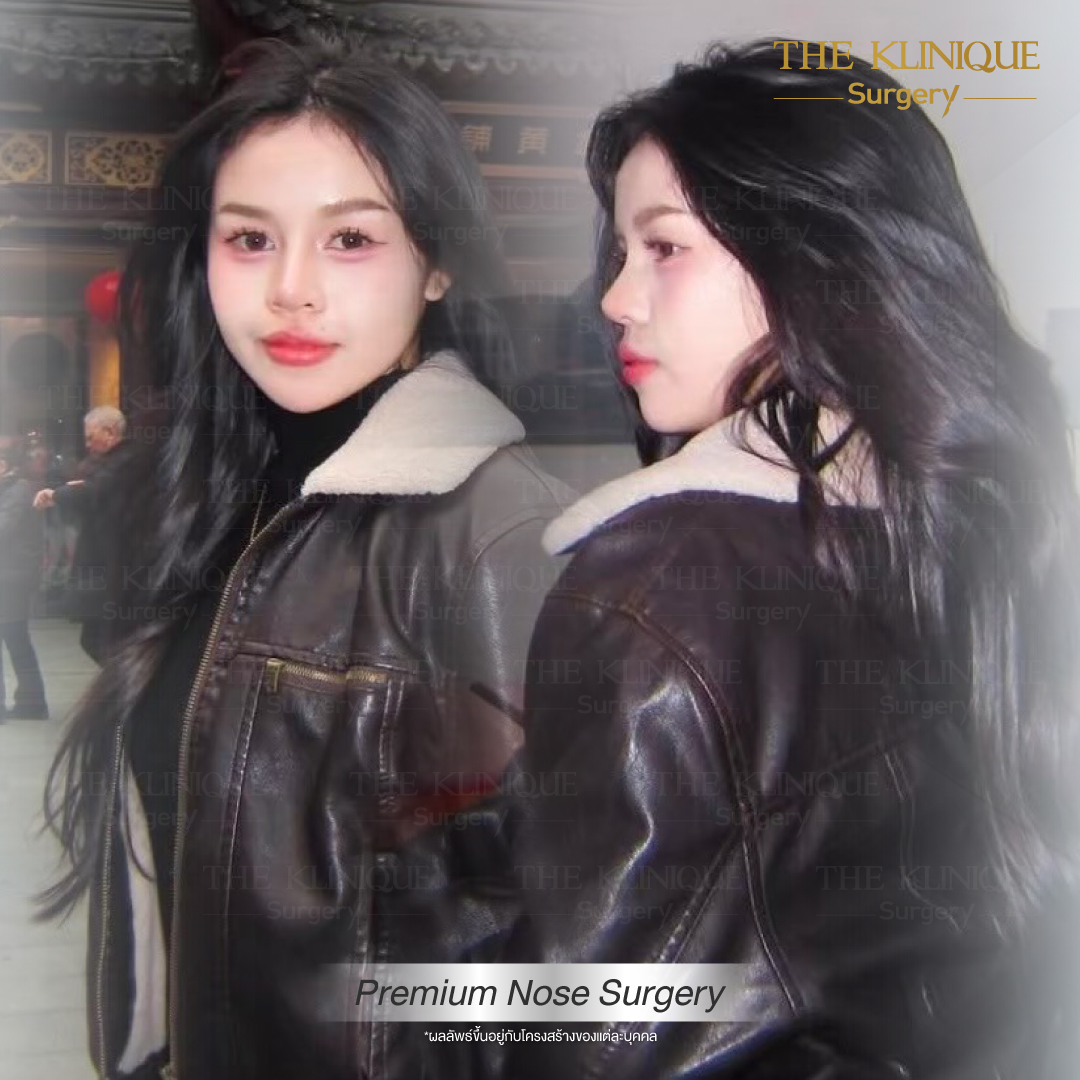 เสริมจมูก, ศัลยกรรมจมูก, ศัลยกรรมจมูก รีวิว, รีวิว เสริมจมูก, ศัลยกรรมจมูกมีกี่แบบ, เสริมจมูกที่ไหนดี, เสริมจมูกโอเพ่น, เสริมจมูกราคา, รีวิวเสริมจมูก, ทำจมูก, ทำจมูก รีวิว, รีวิวทำจมูก, รีวิว ศัลยกรรมจมูก, ซิลิโคนจมูก, แก้จมูก, แก้จมูก รีวิว, รีวิวแก้จมูก, แก้จมูกที่ไหนดี, เสริมจมูก Close, เสริมจมูก semi open, จมูก open, เสริมจมูก Open ที่ไหนดี, รีวิว เสริมจมูก Open, เสริมจมูกโอเพ่น, เสริมจมูกโอเพ่นที่ไหนดี, ทรงจมูก, ทรงจมูกสวย, ทรงจมูกเกาหลี, ทรงจมูกธรรมชาติ, ทรงจมูกสโลปปลายพุ่ง, ทรงจมูกผู้ชาย