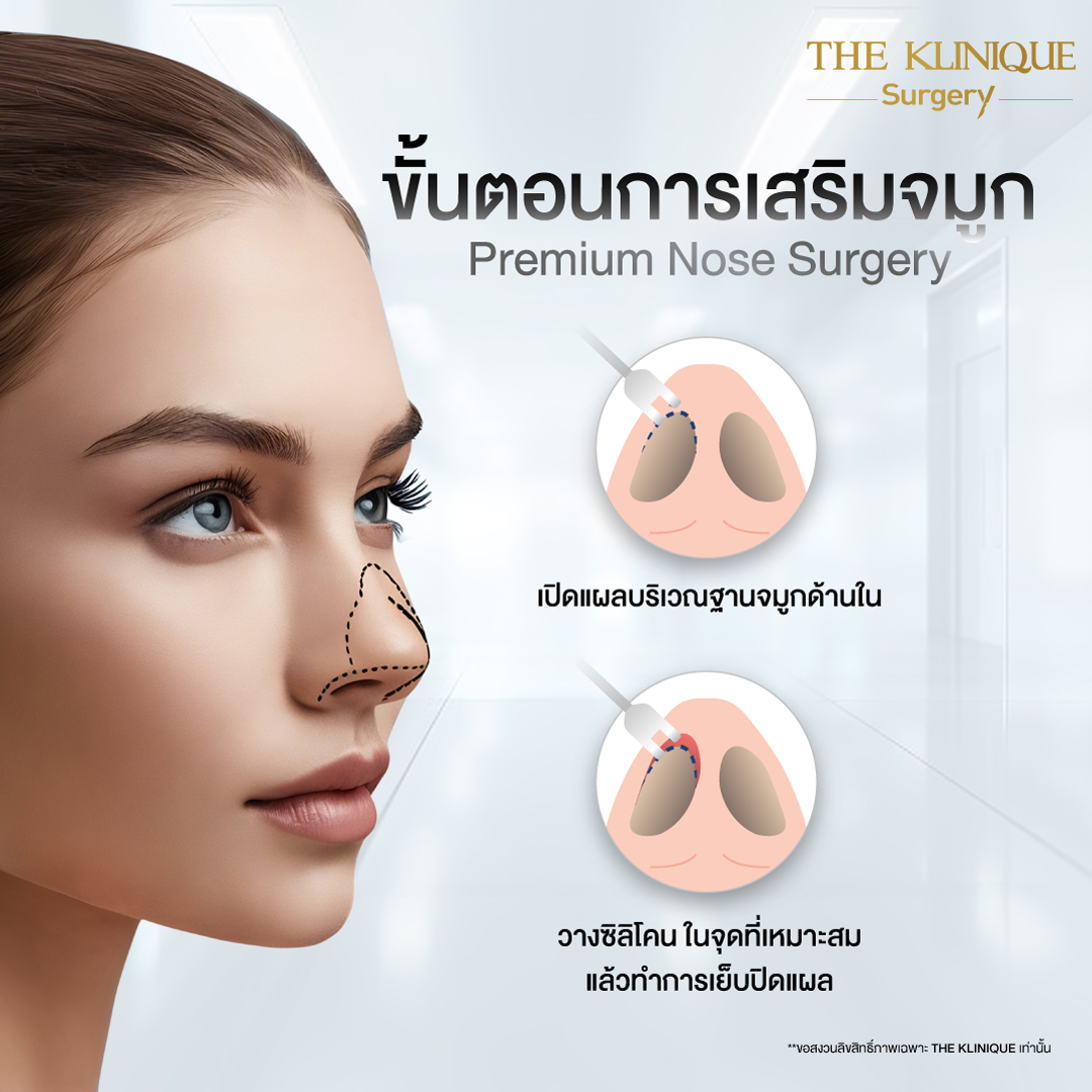 เสริมจมูก, ศัลยกรรมจมูก, ศัลยกรรมจมูก รีวิว, รีวิว เสริมจมูก, ศัลยกรรมจมูกมีกี่แบบ, เสริมจมูกที่ไหนดี, เสริมจมูกโอเพ่น, เสริมจมูกราคา, รีวิวเสริมจมูก, ทำจมูก, ทำจมูก รีวิว, รีวิวทำจมูก, รีวิว ศัลยกรรมจมูก, ซิลิโคนจมูก, แก้จมูก, แก้จมูก รีวิว, รีวิวแก้จมูก, แก้จมูกที่ไหนดี, เสริมจมูก Close, เสริมจมูก semi open, จมูก open, เสริมจมูก Open ที่ไหนดี, รีวิว เสริมจมูก Open, เสริมจมูกโอเพ่น, เสริมจมูกโอเพ่นที่ไหนดี, ทรงจมูก, ทรงจมูกสวย, ทรงจมูกเกาหลี, ทรงจมูกธรรมชาติ, ทรงจมูกสโลปปลายพุ่ง, ทรงจมูกผู้ชาย