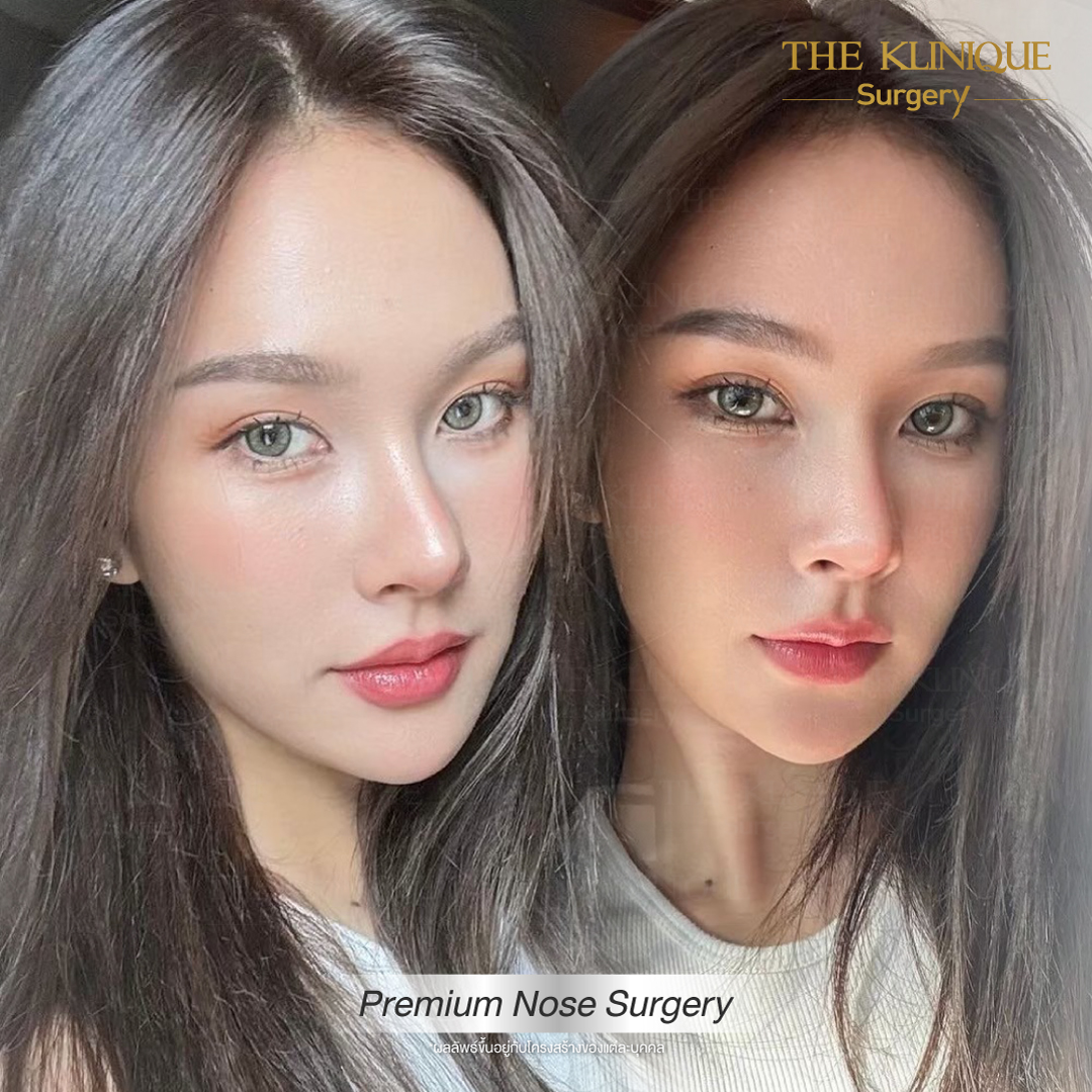 เสริมจมูก, ศัลยกรรมจมูก, ศัลยกรรมจมูก รีวิว, รีวิว เสริมจมูก, ศัลยกรรมจมูกมีกี่แบบ, เสริมจมูกที่ไหนดี, เสริมจมูกโอเพ่น, เสริมจมูกราคา, รีวิวเสริมจมูก, ทำจมูก, ทำจมูก รีวิว, รีวิวทำจมูก, รีวิว ศัลยกรรมจมูก, ซิลิโคนจมูก, แก้จมูก, แก้จมูก รีวิว, รีวิวแก้จมูก, แก้จมูกที่ไหนดี, เสริมจมูก Close, เสริมจมูก semi open, จมูก open, เสริมจมูก Open ที่ไหนดี, รีวิว เสริมจมูก Open, เสริมจมูกโอเพ่น, เสริมจมูกโอเพ่นที่ไหนดี, ทรงจมูก, ทรงจมูกสวย, ทรงจมูกเกาหลี, ทรงจมูกธรรมชาติ, ทรงจมูกสโลปปลายพุ่ง, ทรงจมูกผู้ชาย