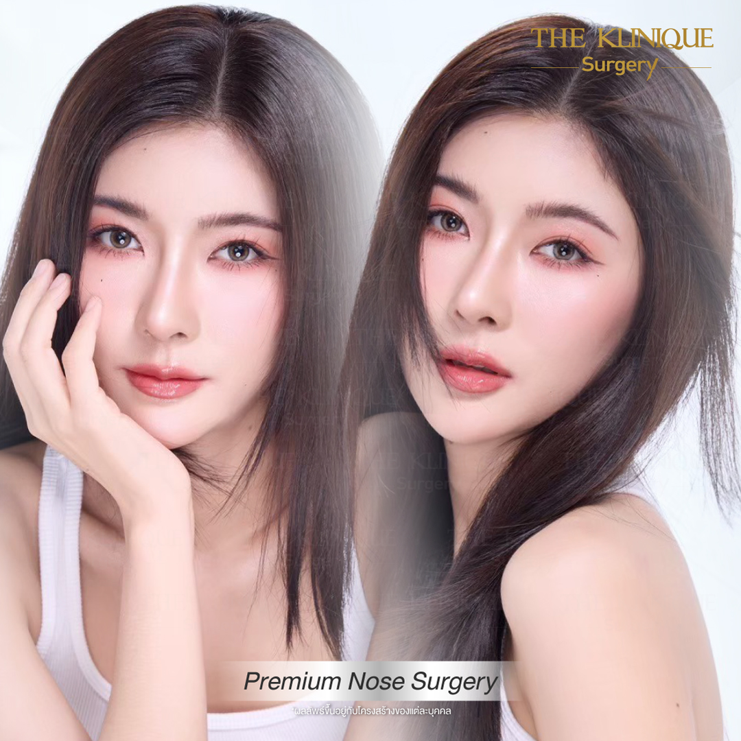 เสริมจมูก, ศัลยกรรมจมูก, ศัลยกรรมจมูก รีวิว, รีวิว เสริมจมูก, ศัลยกรรมจมูกมีกี่แบบ, เสริมจมูกที่ไหนดี, เสริมจมูกโอเพ่น, เสริมจมูกราคา, รีวิวเสริมจมูก, ทำจมูก, ทำจมูก รีวิว, รีวิวทำจมูก, รีวิว ศัลยกรรมจมูก, ซิลิโคนจมูก, แก้จมูก, แก้จมูก รีวิว, รีวิวแก้จมูก, แก้จมูกที่ไหนดี, เสริมจมูก Close, เสริมจมูก semi open, จมูก open, เสริมจมูก Open ที่ไหนดี, รีวิว เสริมจมูก Open, เสริมจมูกโอเพ่น, เสริมจมูกโอเพ่นที่ไหนดี, ทรงจมูก, ทรงจมูกสวย, ทรงจมูกเกาหลี, ทรงจมูกธรรมชาติ, ทรงจมูกสโลปปลายพุ่ง, ทรงจมูกผู้ชาย