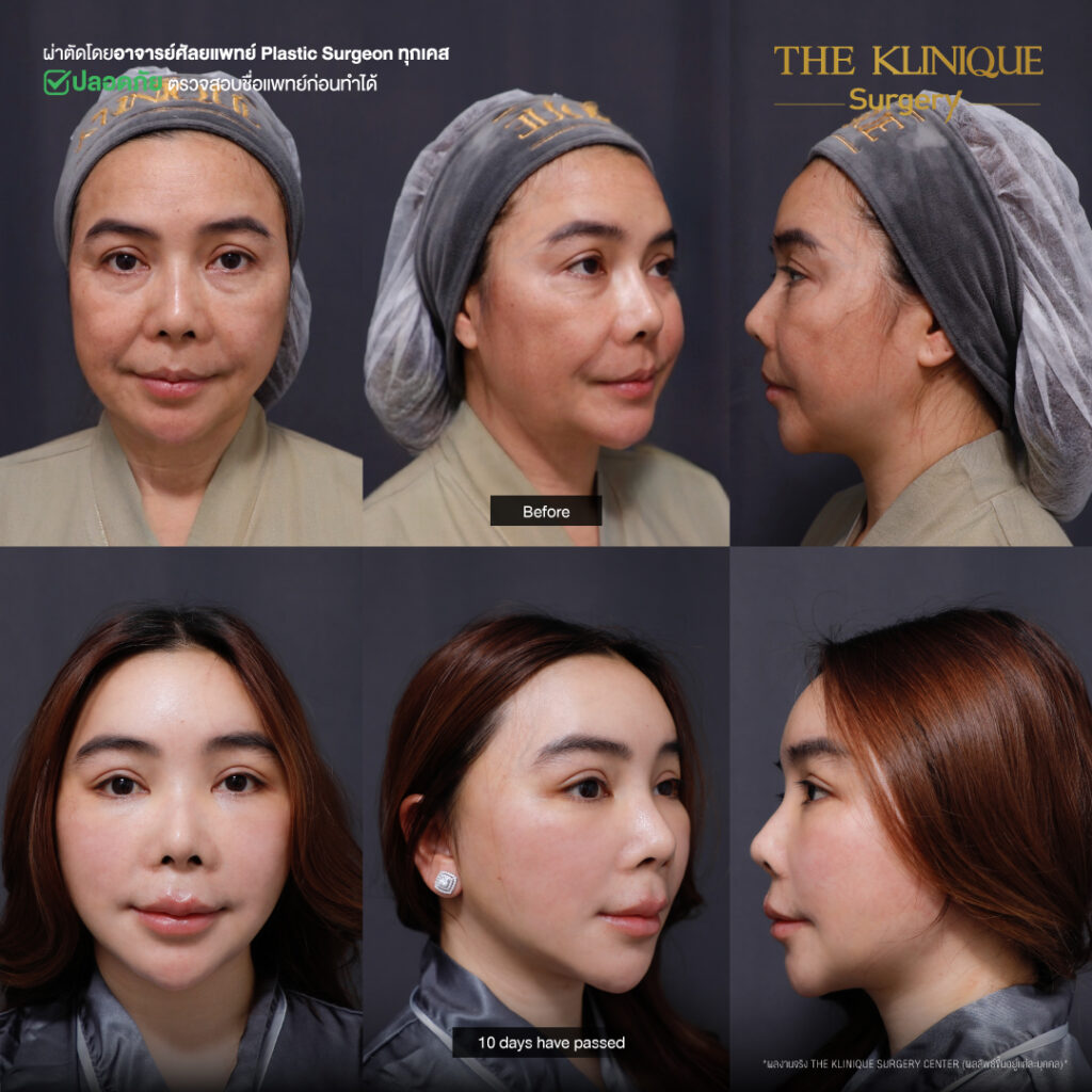 ศัลยกรรมดึงหน้า, ดึงหน้า, ดึงหน้าผาก, ดึงหน้าผาก ยกคิ้ว, Face Lock, Face Lift, ดึงหน้า ดึงคอ, ดึงหน้าย้อนวัย, ดึงหน้าดารา, Necklift, Face Lift คือ,Endotine หน้าผาก,ดึงหน้าผาก ยกคิ้ว, ศัลยกรรมดึงหน้าผาก, ดึงหน้าย้อนวัย, ศัลยกรรมยกคิ้ว, รีวิวศัลยกรรมยกคิ้ว, Endotine, Endotine รีวิว, ยกคิ้วส่องกล้อง, ผ่าตัดส่องกล้อง, ผ่าตัดดึงหน้า, Endotine รีวิว, ยกคิ้ว รีวิว, ยกคิ้วส่องกล้อง, ยกคิ้วส่องกล้อง รีวิว, ยกคิ้วที่ไหนดี