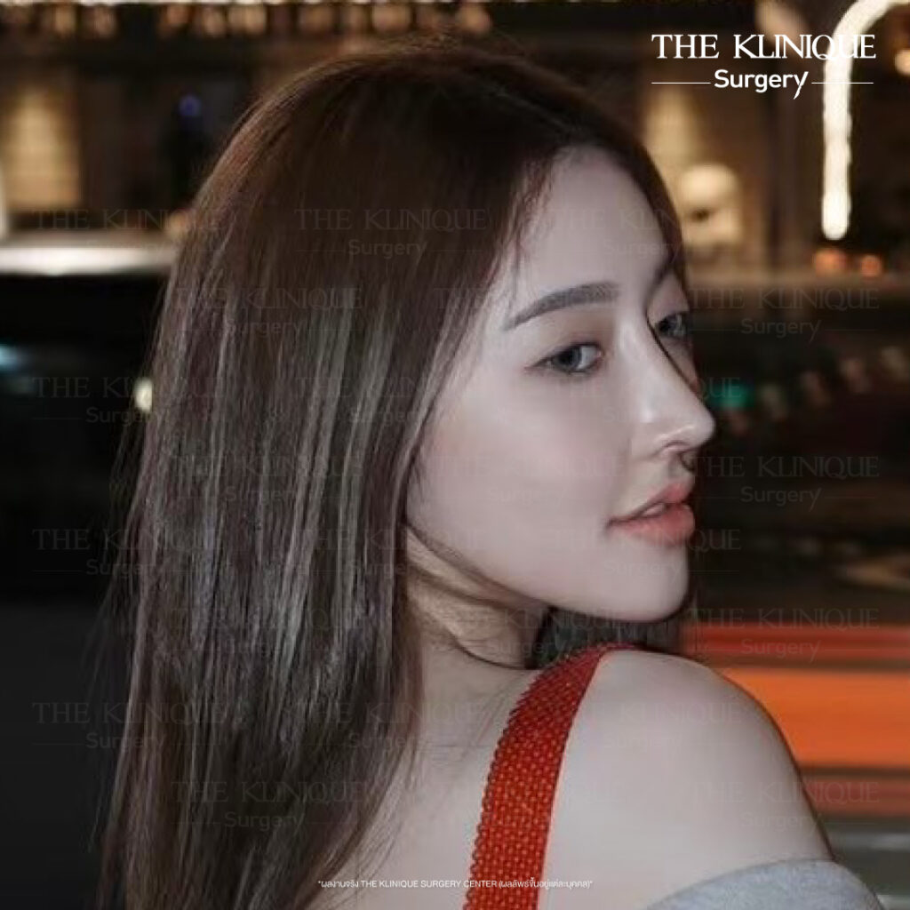 ศัลยกรรมจมูก, เสริมจมูก, เสริมจมูกที่ไหนดี, เสริมจมูกราคา, รีวิว เสริมจมูก, ทำจมูก, ทำจมูก รีวิว,เสริมจมูก Semi Open, เสริมจมูก Open, เสริมจมูก โอเพ่น, ซิลิโคนจมูก, จมูกOpen, รีวิวเสริมจมูกโอเพ่น, รีวิวเสริมจมูก Open, ทรงจมูก, ทรงจมูกสวย, ทรงจมูกเกาหลี, ทรงจมูกธรรมชาติ, ทรงจมูกสันสโลปปลายพุ่ง,รีวิวจมูกOpen, หลังเสริมจมูก, ศัลยกรรมเสริมจมูก, ศัลยกรรมเสริมจมูกราคา, ศัลยกรรมเสริมจมูกที่ไหนดี, เสริมจมูกที่ไหนดี, ศัลยกรรมจมูกมีกี่แบบ, เสริมจมูก Close, เสริมจมูก Open ที่ไหนดี, เสริมจมูกโอเพ่นทีไ่หนดี, รีวิวจมูกOpen, รีวิวเสริมจมูกOpen, แก้จมูก, แก้จมูกที่ไหนดี,