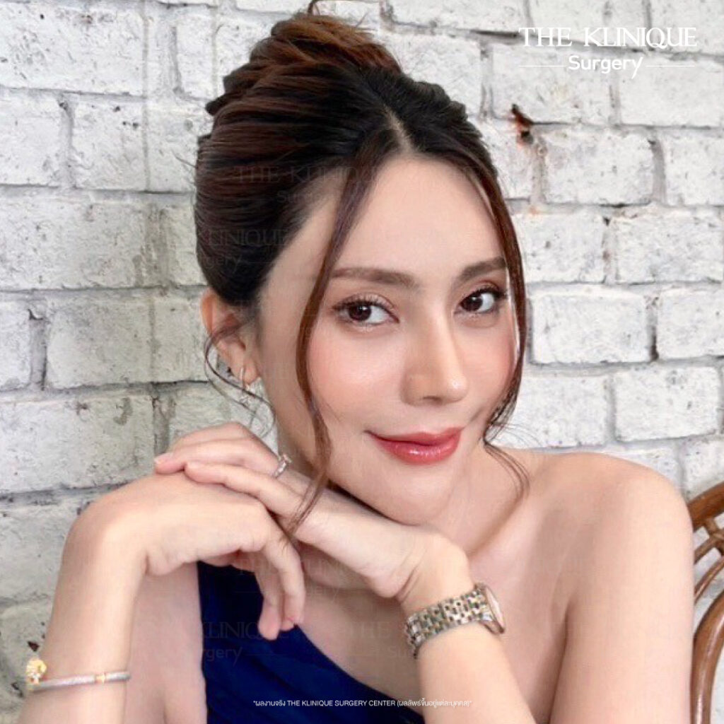 ศัลยกรรมจมูก, เสริมจมูก, เสริมจมูกที่ไหนดี, เสริมจมูกราคา, รีวิว เสริมจมูก, ทำจมูก, ทำจมูก รีวิว,เสริมจมูก Semi Open, เสริมจมูก Open, เสริมจมูก โอเพ่น, ซิลิโคนจมูก, จมูกOpen, รีวิวเสริมจมูกโอเพ่น, รีวิวเสริมจมูก Open, ทรงจมูก, ทรงจมูกสวย, ทรงจมูกเกาหลี, ทรงจมูกธรรมชาติ, ทรงจมูกสันสโลปปลายพุ่ง,รีวิวจมูกOpen, หลังเสริมจมูก, ศัลยกรรมเสริมจมูก, ศัลยกรรมเสริมจมูกราคา, ศัลยกรรมเสริมจมูกที่ไหนดี, เสริมจมูกที่ไหนดี, ศัลยกรรมจมูกมีกี่แบบ, เสริมจมูก Close, เสริมจมูก Open ที่ไหนดี, เสริมจมูกโอเพ่นทีไ่หนดี, รีวิวจมูกOpen, รีวิวเสริมจมูกOpen, แก้จมูก, แก้จมูกที่ไหนดี,