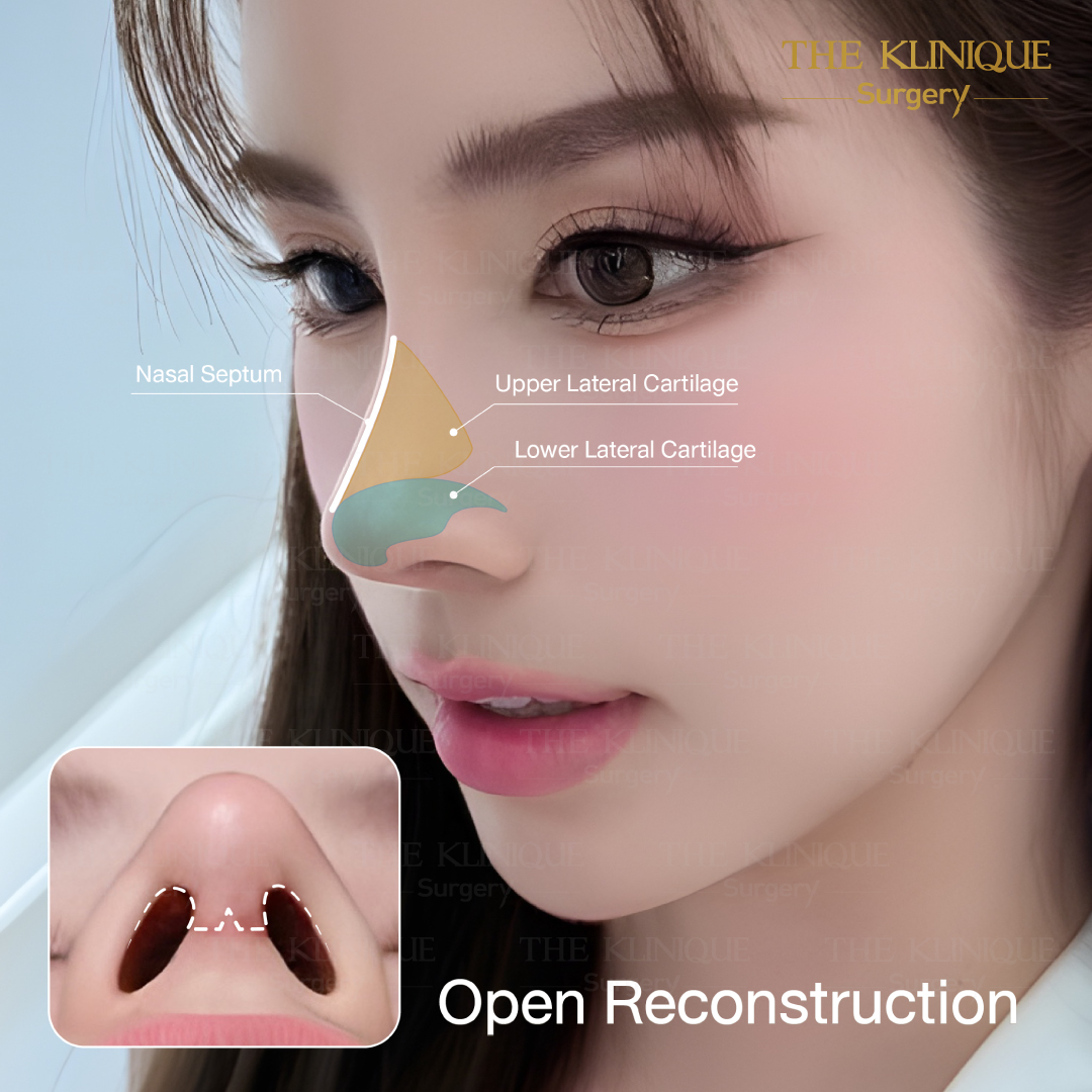 ศัลยกรรมจมูก, เสริมจมูก, เสริมจมูกที่ไหนดี, เสริมจมูกราคา, รีวิว เสริมจมูก, ทำจมูก, ทำจมูก รีวิว,เสริมจมูก Semi Open, เสริมจมูก Open, เสริมจมูก โอเพ่น, ซิลิโคนจมูก, จมูกOpen, รีวิวเสริมจมูกโอเพ่น, รีวิวเสริมจมูก Open, ทรงจมูก, ทรงจมูกสวย, ทรงจมูกเกาหลี, ทรงจมูกธรรมชาติ, ทรงจมูกสันสโลปปลายพุ่ง,รีวิวจมูกOpen, หลังเสริมจมูก, ศัลยกรรมเสริมจมูก, ศัลยกรรมเสริมจมูกราคา, ศัลยกรรมเสริมจมูกที่ไหนดี, เสริมจมูกที่ไหนดี, ศัลยกรรมจมูกมีกี่แบบ, เสริมจมูก Close, เสริมจมูก Open ที่ไหนดี, เสริมจมูกโอเพ่นทีไ่หนดี, รีวิวจมูกOpen, รีวิวเสริมจมูกOpen, แก้จมูก, แก้จมูกที่ไหนดี,