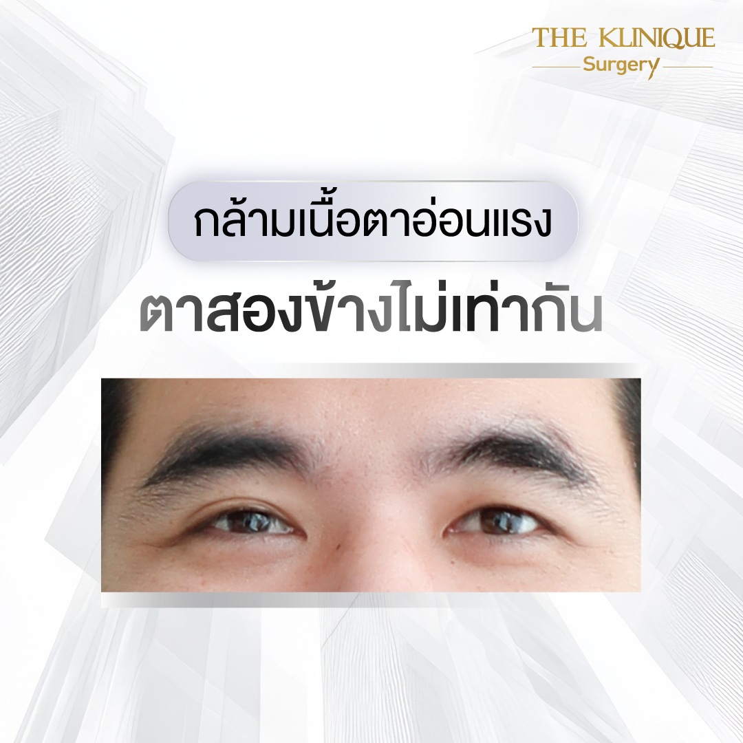 Endotine, ยกคิ้ว Endotine, เอนโดไทน์, Foxy Eyes, ศัลยกรรมยกคิ้ว, รีวิว ศัลยกรรมยกคิ้ว, ยกคิ้ว, ยกคิ้วส่องกล้อง, ยกคิ้วส่องกล้อง รีวิว, ยกคิ้วที่ไหนดี, แก้ตาไม่เท่ากัน,Foxy Eyes, ศัลยกรรมตา, ตาสองชั้น, คลินิกทำตา, ทำตาสองชั้น. ทำตา2ชั้น, กล้ามเนื้อตาอ่อนแรง, แก้ตา, แก้หนังตาตก,หางตาตก, ตาตก,ยกหางตา, แก้ตาสองชั้น,หนังตาตก, ดึงหน้าดารา
