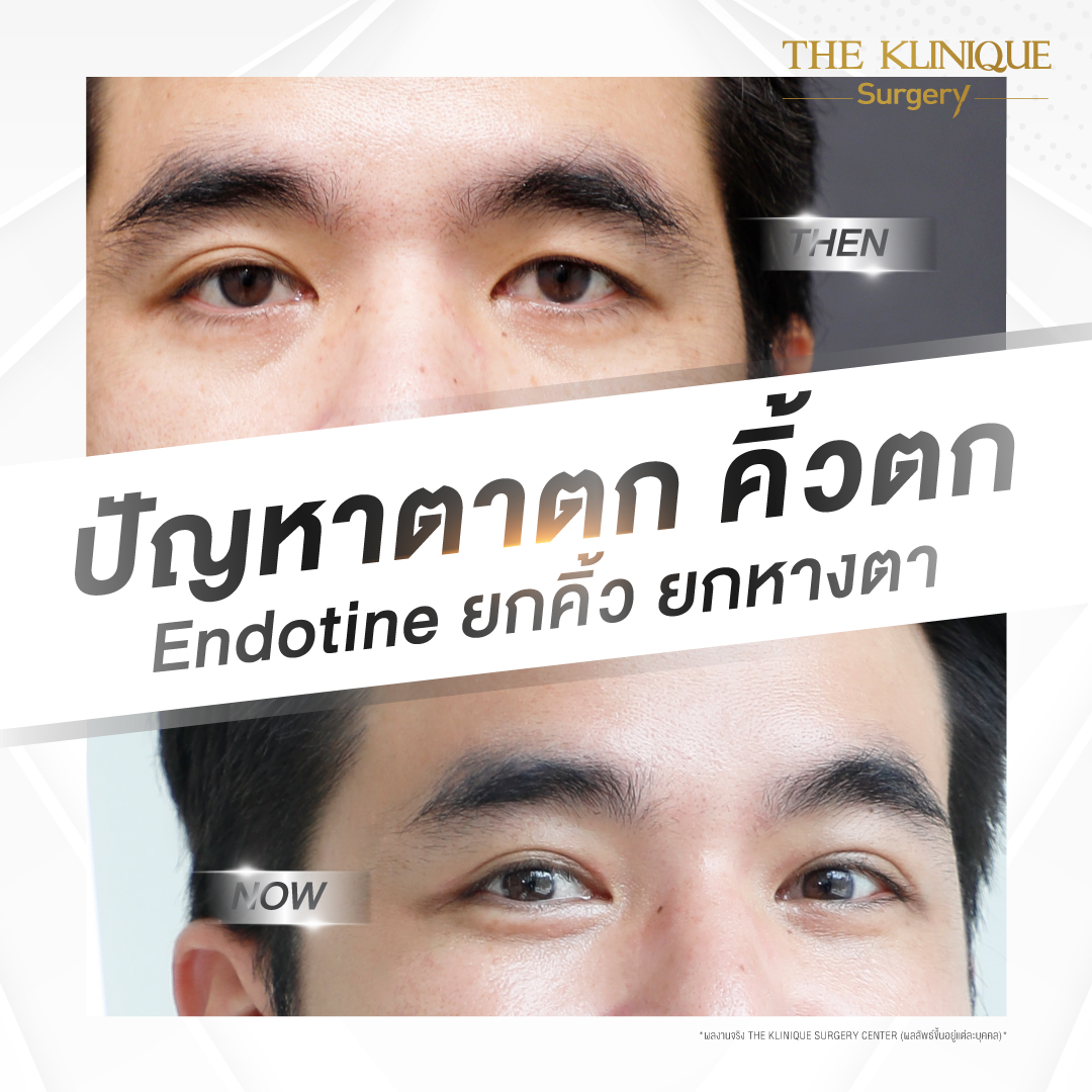 Endotine, ยกคิ้ว Endotine, เอนโดไทน์, Foxy Eyes, ศัลยกรรมยกคิ้ว, รีวิว ศัลยกรรมยกคิ้ว, ยกคิ้ว, ยกคิ้วส่องกล้อง, ยกคิ้วส่องกล้อง รีวิว, ยกคิ้วที่ไหนดี, แก้ตาไม่เท่ากัน,Foxy Eyes, ศัลยกรรมตา, ตาสองชั้น, คลินิกทำตา, ทำตาสองชั้น. ทำตา2ชั้น, กล้ามเนื้อตาอ่อนแรง, แก้ตา, แก้หนังตาตก,หางตาตก, ตาตก,ยกหางตา, แก้ตาสองชั้น,หนังตาตก, ดึงหน้าดารา