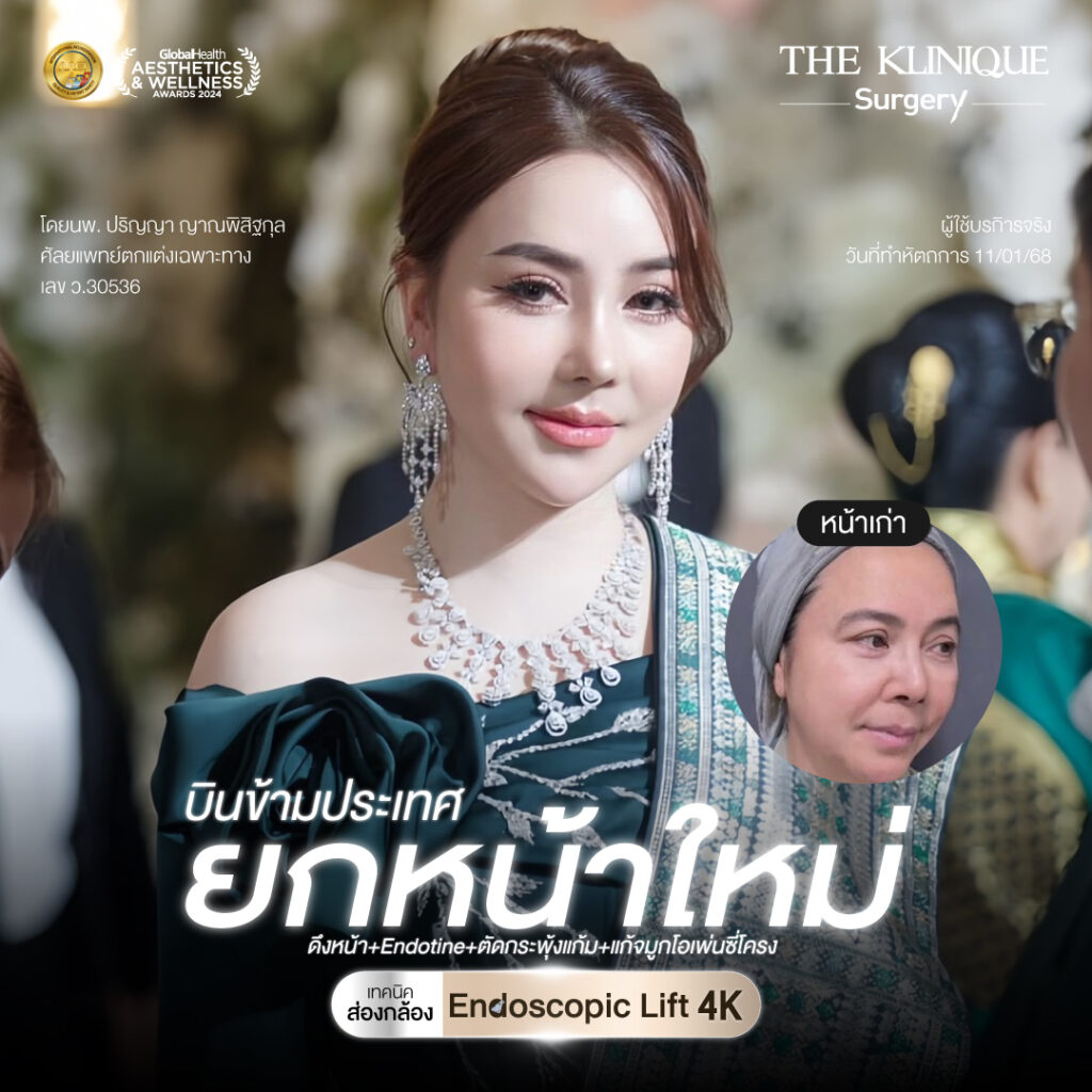 ศัลยกรรมดึงหน้า, ดึงหน้า, ดึงหน้าผาก, ดึงหน้าผาก ยกคิ้ว, Face Lock, Face Lift, ดึงหน้า ดึงคอ, ดึงหน้าย้อนวัย, ดึงหน้าดารา, Necklift, Face Lift คือ,Endotine หน้าผาก,ดึงหน้าผาก ยกคิ้ว, ศัลยกรรมดึงหน้าผาก, ดึงหน้าย้อนวัย, ศัลยกรรมยกคิ้ว, รีวิวศัลยกรรมยกคิ้ว, Endotine, Endotine รีวิว, ยกคิ้วส่องกล้อง, ผ่าตัดส่องกล้อง, ผ่าตัดดึงหน้า, Endotine รีวิว, ยกคิ้ว รีวิว, ยกคิ้วส่องกล้อง, ยกคิ้วส่องกล้อง รีวิว, ยกคิ้วที่ไหนดี