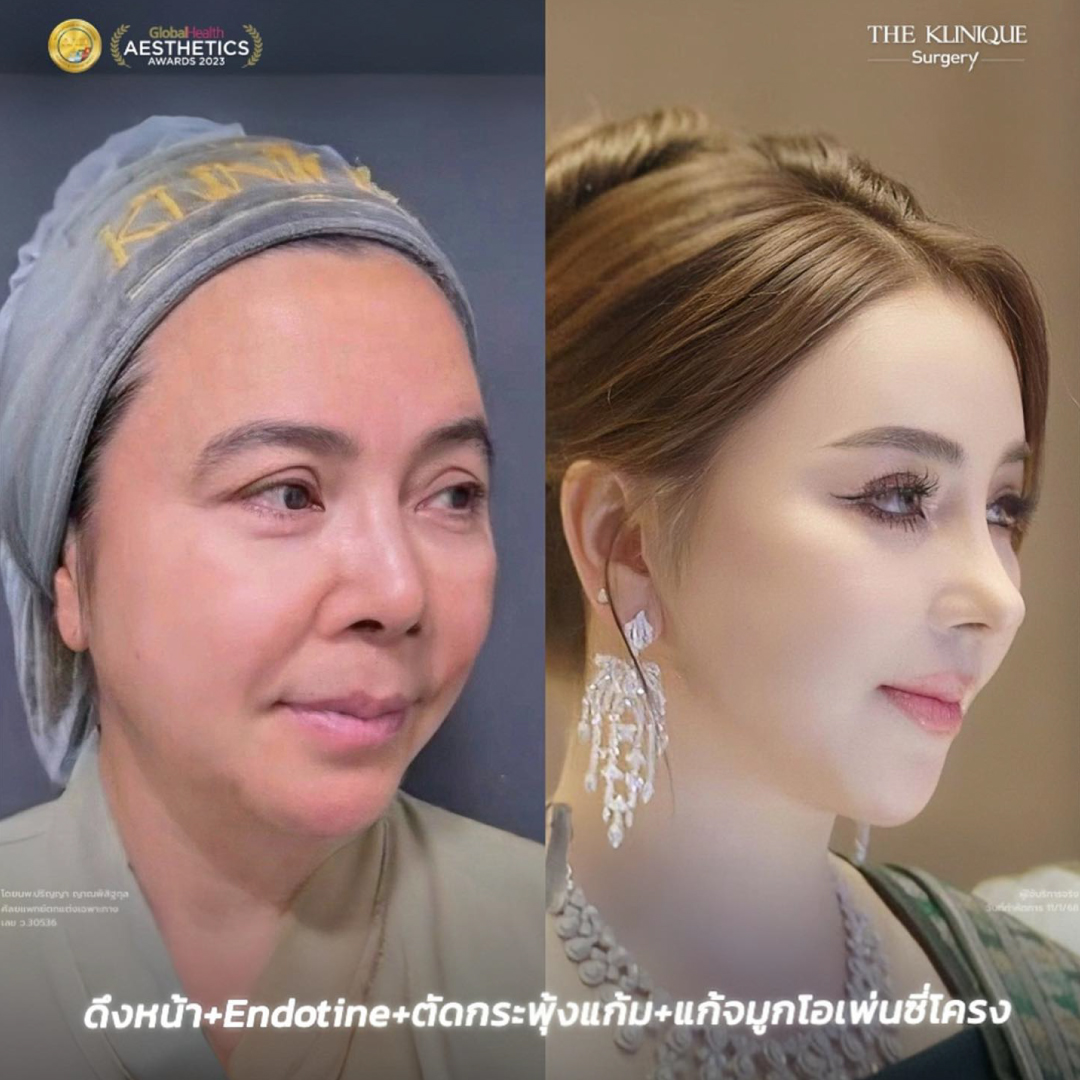 ศัลยกรรมดึงหน้า, ดึงหน้า, ดึงหน้าผาก, ดึงหน้าผาก ยกคิ้ว, Face Lock, Face Lift, ดึงหน้า ดึงคอ, ดึงหน้าย้อนวัย, ดึงหน้าดารา, Necklift, Face Lift คือ,Endotine หน้าผาก,ดึงหน้าผาก ยกคิ้ว, ศัลยกรรมดึงหน้าผาก, ดึงหน้าย้อนวัย, ศัลยกรรมยกคิ้ว, รีวิวศัลยกรรมยกคิ้ว, Endotine, Endotine รีวิว, ยกคิ้วส่องกล้อง, ผ่าตัดส่องกล้อง, ผ่าตัดดึงหน้า, Endotine รีวิว, ยกคิ้ว รีวิว, ยกคิ้วส่องกล้อง, ยกคิ้วส่องกล้อง รีวิว, ยกคิ้วที่ไหนดี