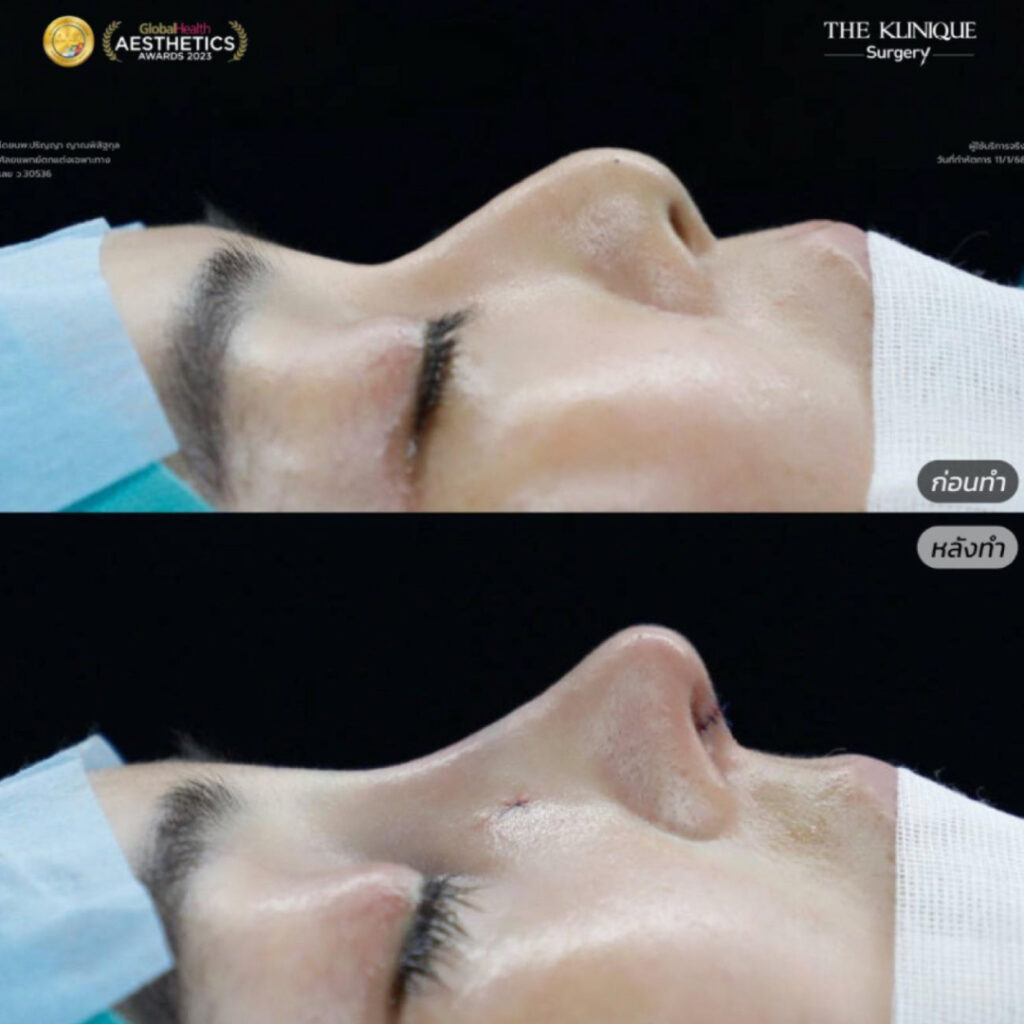 ศัลยกรรมดึงหน้า, ดึงหน้า, ดึงหน้าผาก, ดึงหน้าผาก ยกคิ้ว, Face Lock, Face Lift, ดึงหน้า ดึงคอ, ดึงหน้าย้อนวัย, ดึงหน้าดารา, Necklift, Face Lift คือ,Endotine หน้าผาก,ดึงหน้าผาก ยกคิ้ว, ศัลยกรรมดึงหน้าผาก, ดึงหน้าย้อนวัย, ศัลยกรรมยกคิ้ว, รีวิวศัลยกรรมยกคิ้ว, Endotine, Endotine รีวิว, ยกคิ้วส่องกล้อง, ผ่าตัดส่องกล้อง, ผ่าตัดดึงหน้า, Endotine รีวิว, ยกคิ้ว รีวิว, ยกคิ้วส่องกล้อง, ยกคิ้วส่องกล้อง รีวิว, ยกคิ้วที่ไหนดี
