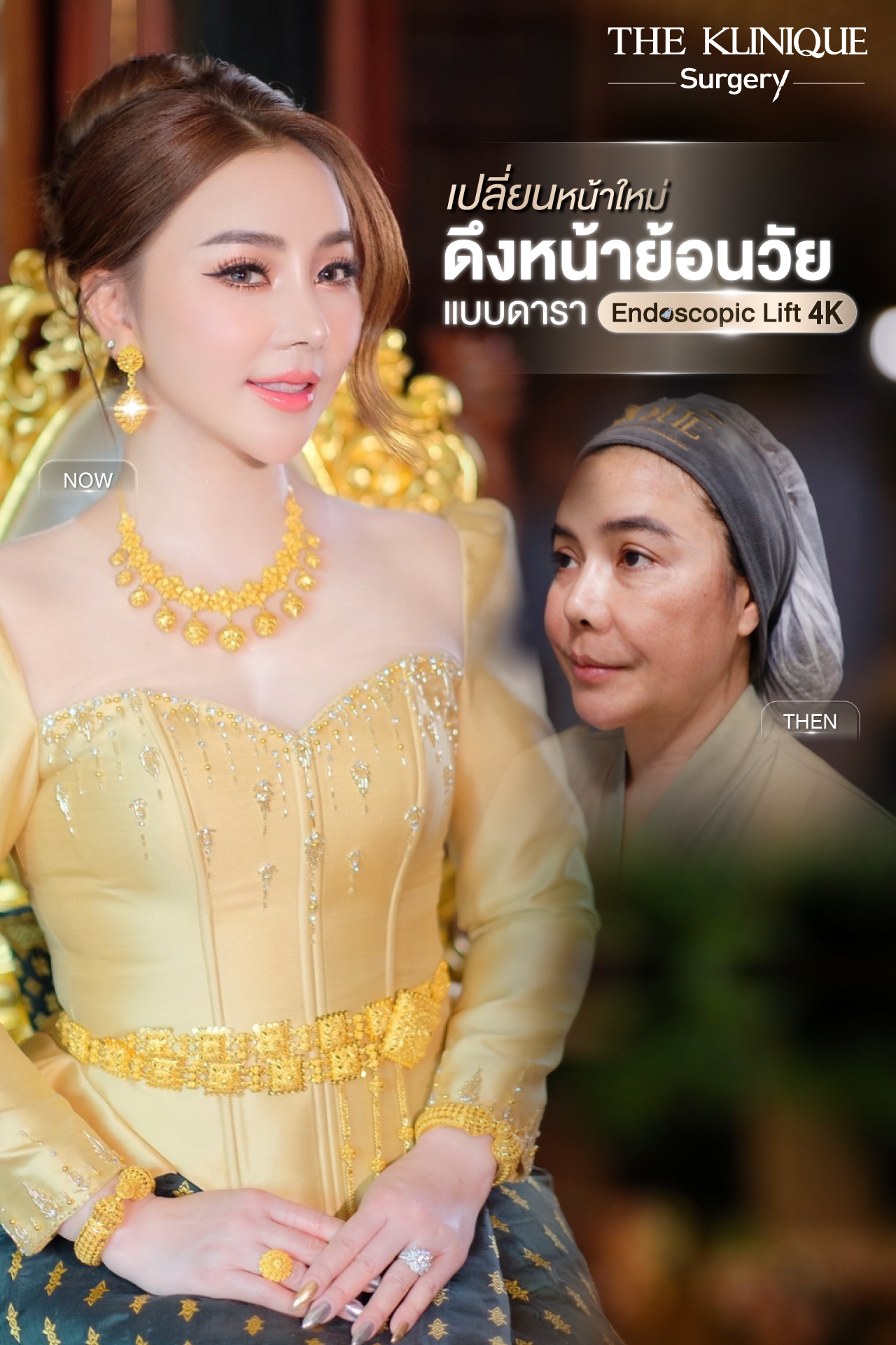 ศัลยกรรมดึงหน้า, ดึงหน้า, ดึงหน้าผาก, ดึงหน้าผาก ยกคิ้ว, Face Lock, Face Lift, ดึงหน้า ดึงคอ, ดึงหน้าย้อนวัย, ดึงหน้าดารา, Necklift, Face Lift คือ,Endotine หน้าผาก,ดึงหน้าผาก ยกคิ้ว, ศัลยกรรมดึงหน้าผาก, ดึงหน้าย้อนวัย, ศัลยกรรมยกคิ้ว, รีวิวศัลยกรรมยกคิ้ว, Endotine, Endotine รีวิว, ยกคิ้วส่องกล้อง, ผ่าตัดส่องกล้อง, ผ่าตัดดึงหน้า, Endotine รีวิว, ยกคิ้ว รีวิว, ยกคิ้วส่องกล้อง, ยกคิ้วส่องกล้อง รีวิว, ยกคิ้วที่ไหนดี