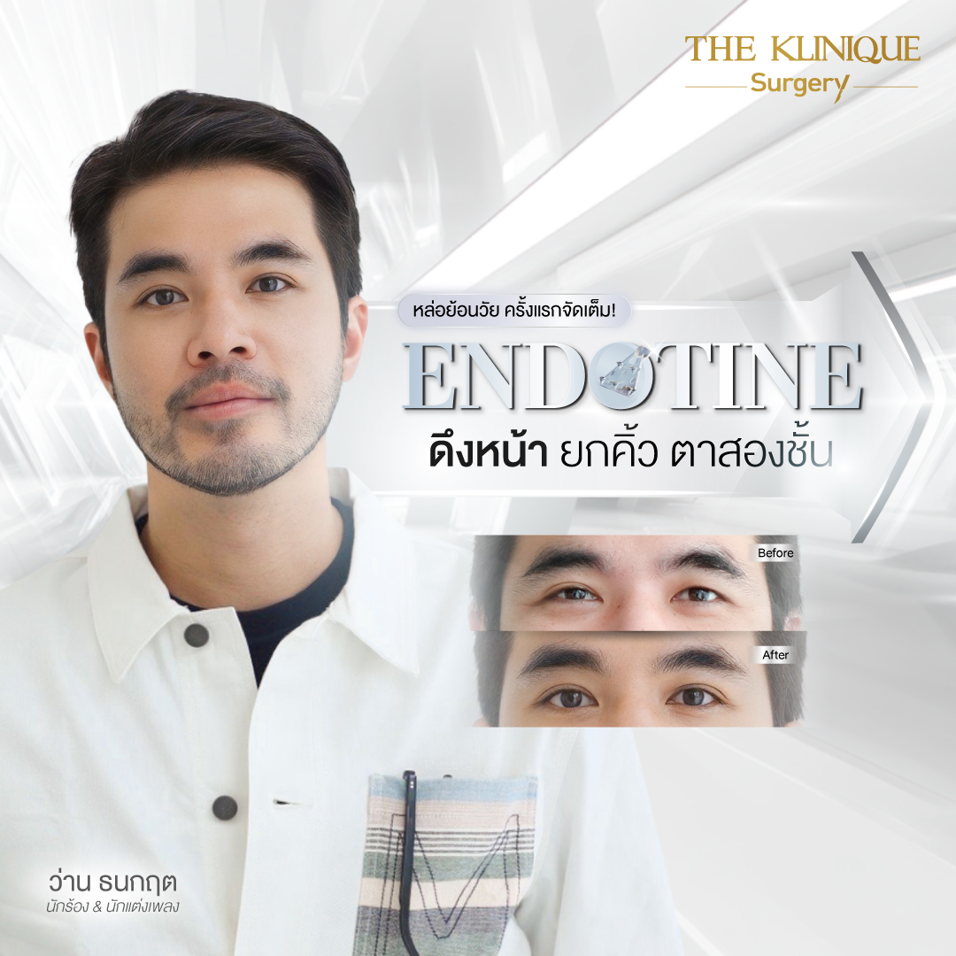Endotine, ยกคิ้ว Endotine, เอนโดไทน์, Foxy Eyes, ศัลยกรรมยกคิ้ว, รีวิว ศัลยกรรมยกคิ้ว, ยกคิ้ว, ยกคิ้วส่องกล้อง, ยกคิ้วส่องกล้อง รีวิว, ยกคิ้วที่ไหนดี, แก้ตาไม่เท่ากัน,Foxy Eyes, ศัลยกรรมตา, ตาสองชั้น, คลินิกทำตา, ทำตาสองชั้น. ทำตา2ชั้น, กล้ามเนื้อตาอ่อนแรง, แก้ตา, แก้หนังตาตก,หางตาตก, ตาตก,ยกหางตา, แก้ตาสองชั้น,หนังตาตก, ดึงหน้าดารา