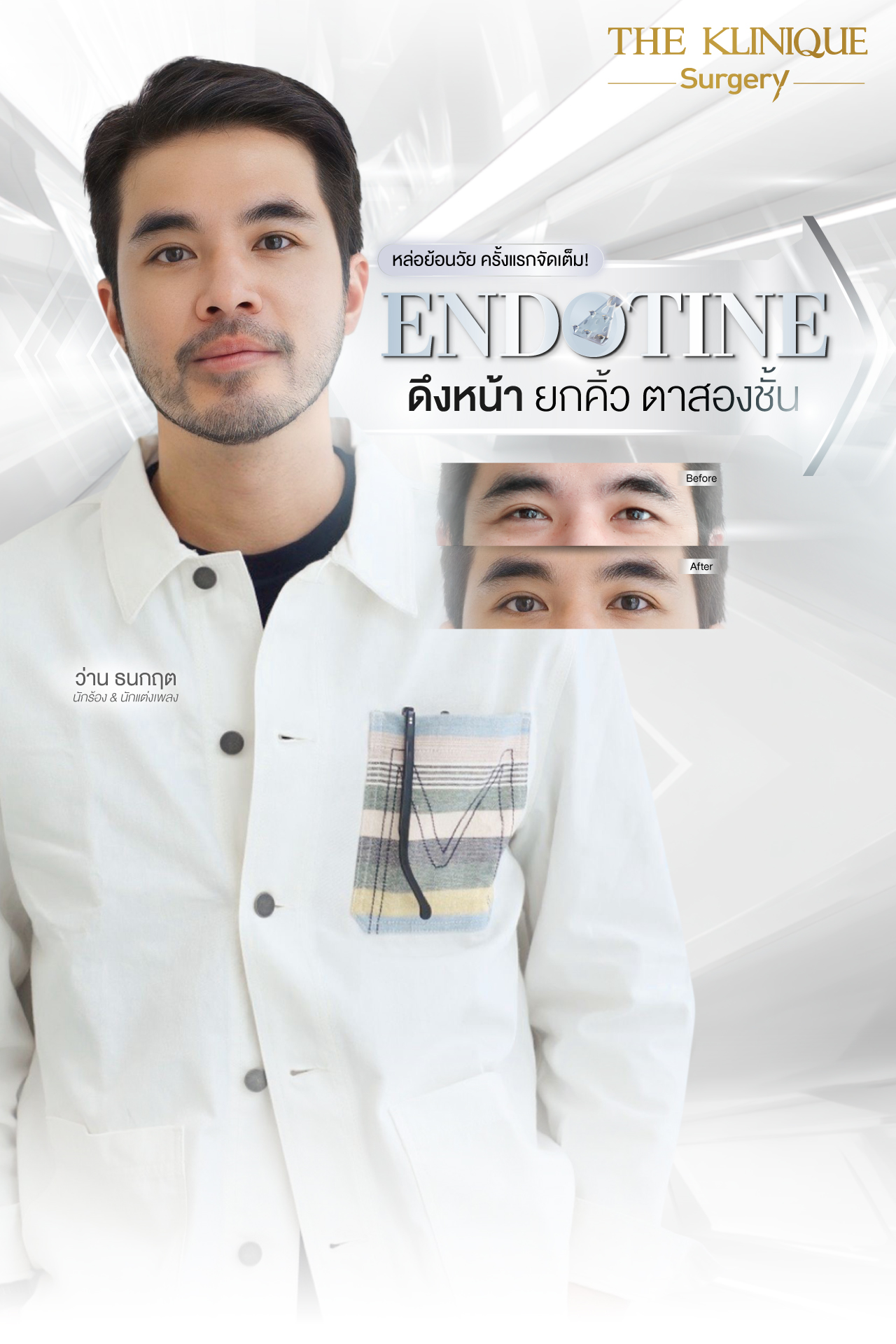 Endotine, ยกคิ้ว Endotine, เอนโดไทน์, Foxy Eyes, ศัลยกรรมยกคิ้ว, รีวิว ศัลยกรรมยกคิ้ว, ยกคิ้ว, ยกคิ้วส่องกล้อง, ยกคิ้วส่องกล้อง รีวิว, ยกคิ้วที่ไหนดี, แก้ตาไม่เท่ากัน,Foxy Eyes, ศัลยกรรมตา, ตาสองชั้น, คลินิกทำตา, ทำตาสองชั้น. ทำตา2ชั้น, กล้ามเนื้อตาอ่อนแรง, แก้ตา, แก้หนังตาตก,หางตาตก, ตาตก,ยกหางตา, แก้ตาสองชั้น,หนังตาตก, ดึงหน้าดารา