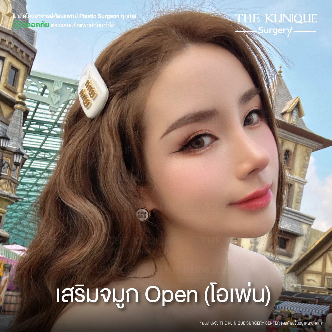 จมูก พส. จีน, หน้า พส จีน, พส จีน, V-Line, หน้า V-Line, Endoscopic, ศัลยกรรมคาง, เสริมคาง, เสริมคาง ปรับรูปหน้า, ตัดกราม
