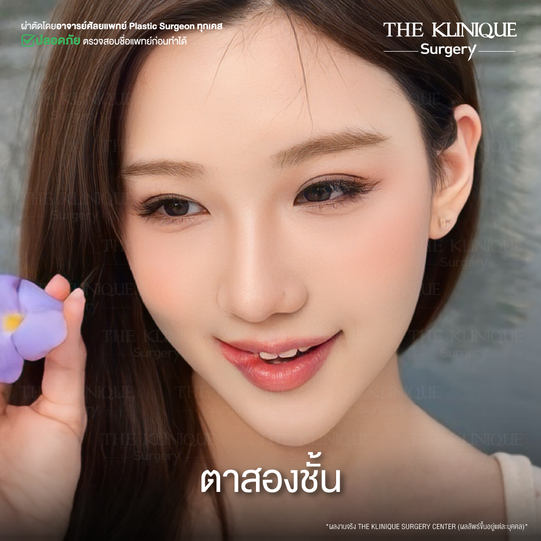 จมูก พส. จีน, หน้า พส จีน, พส จีน, V-Line, หน้า V-Line, Endoscopic, ศัลยกรรมคาง, เสริมคาง, เสริมคาง ปรับรูปหน้า, ตัดกราม