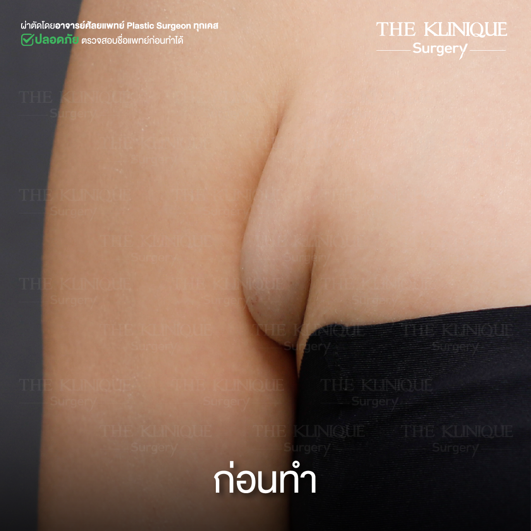 Liposuction, Sculpting,Xshape,Lipo, ศัลยกรรมดูดไขมัน, ดูดไขมัน,คลินิกดูดไขมัน,ดูดไขมันเฉพาะส่วน,ดูดไขมันเหนียง,ดูดไขมันหน้าท้อง,ดูดไขมันรีวิว, รีวิวดูดไขมัน, รีวิวดูดไขมันหน้าท้อง,ดูดไขมันต้นแขน, ดูดไขมันต้นขา,ดูดไขมันน่อง, ลดความอ้วน, ดูดไขมันที่ไหนดี, ดูดไขมันราคา, ดูดไขมันทั้งตัว, รีวิว ดูดไขมันต้นขา, ดูดไขมันขา