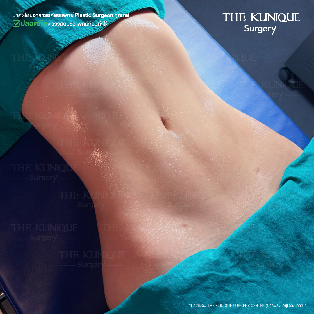 Liposuction, Sculpting,Xshape,Lipo, ศัลยกรรมดูดไขมัน, ดูดไขมัน,คลินิกดูดไขมัน,ดูดไขมันเฉพาะส่วน,ดูดไขมันเหนียง,ดูดไขมันหน้าท้อง,ดูดไขมันรีวิว, รีวิวดูดไขมัน, รีวิวดูดไขมันหน้าท้อง,ดูดไขมันต้นแขน, ดูดไขมันต้นขา,ดูดไขมันน่อง, ลดความอ้วน, ดูดไขมันที่ไหนดี, ดูดไขมันราคา, ดูดไขมันทั้งตัว, รีวิว ดูดไขมันต้นขา, ดูดไขมันขา
