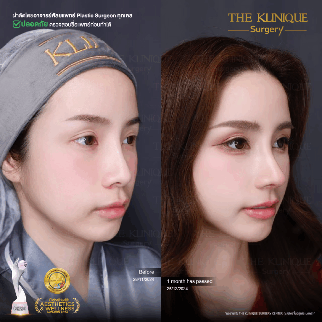 เสริมจมูก, ศัลยกรรมจมูก, ศัลยกรรมจมูก รีวิว, รีวิว เสริมจมูก, ศัลยกรรมจมูกมีกี่แบบ, เสริมจมูกที่ไหนดี, เสริมจมูกโอเพ่น, เสริมจมูกราคา, รีวิวเสริมจมูก, ทำจมูก, ทำจมูก รีวิว, รีวิวทำจมูก, รีวิว ศัลยกรรมจมูก, ซิลิโคนจมูก, แก้จมูก, แก้จมูก รีวิว, รีวิวแก้จมูก, แก้จมูกที่ไหนดี, เสริมจมูก Close, เสริมจมูก semi open, จมูก open, เสริมจมูก Open ที่ไหนดี, รีวิว เสริมจมูก Open, เสริมจมูกโอเพ่น, เสริมจมูกโอเพ่นที่ไหนดี, ทรงจมูก, ทรงจมูกสวย, ทรงจมูกเกาหลี, ทรงจมูกธรรมชาติ, ทรงจมูกสโลปปลายพุ่ง, ทรงจมูกผู้ชาย