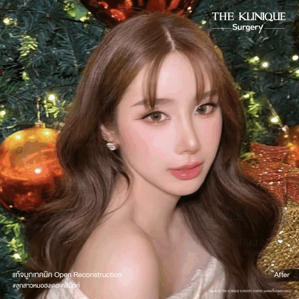 เสริมจมูก, ศัลยกรรมจมูก, ศัลยกรรมจมูก รีวิว, รีวิว เสริมจมูก, ศัลยกรรมจมูกมีกี่แบบ, เสริมจมูกที่ไหนดี, เสริมจมูกโอเพ่น, เสริมจมูกราคา, รีวิวเสริมจมูก, ทำจมูก, ทำจมูก รีวิว, รีวิวทำจมูก, รีวิว ศัลยกรรมจมูก, ซิลิโคนจมูก, แก้จมูก, แก้จมูก รีวิว, รีวิวแก้จมูก, แก้จมูกที่ไหนดี, เสริมจมูก Close, เสริมจมูก semi open, จมูก open, เสริมจมูก Open ที่ไหนดี, รีวิว เสริมจมูก Open, เสริมจมูกโอเพ่น, เสริมจมูกโอเพ่นที่ไหนดี, ทรงจมูก, ทรงจมูกสวย, ทรงจมูกเกาหลี, ทรงจมูกธรรมชาติ, ทรงจมูกสโลปปลายพุ่ง, ทรงจมูกผู้ชาย