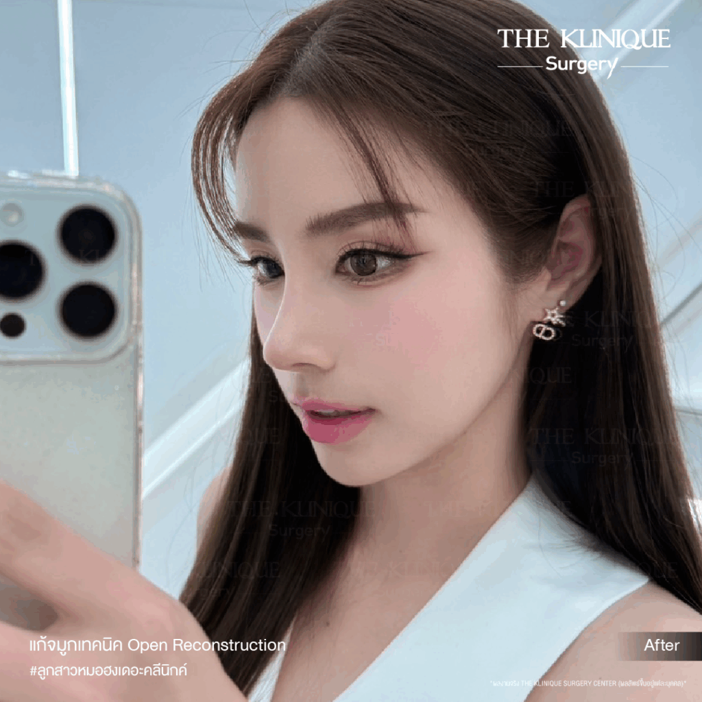 เสริมจมูก, ศัลยกรรมจมูก, ศัลยกรรมจมูก รีวิว, รีวิว เสริมจมูก, ศัลยกรรมจมูกมีกี่แบบ, เสริมจมูกที่ไหนดี, เสริมจมูกโอเพ่น, เสริมจมูกราคา, รีวิวเสริมจมูก, ทำจมูก, ทำจมูก รีวิว, รีวิวทำจมูก, รีวิว ศัลยกรรมจมูก, ซิลิโคนจมูก, แก้จมูก, แก้จมูก รีวิว, รีวิวแก้จมูก, แก้จมูกที่ไหนดี, เสริมจมูก Close, เสริมจมูก semi open, จมูก open, เสริมจมูก Open ที่ไหนดี, รีวิว เสริมจมูก Open, เสริมจมูกโอเพ่น, เสริมจมูกโอเพ่นที่ไหนดี, ทรงจมูก, ทรงจมูกสวย, ทรงจมูกเกาหลี, ทรงจมูกธรรมชาติ, ทรงจมูกสโลปปลายพุ่ง, ทรงจมูกผู้ชาย