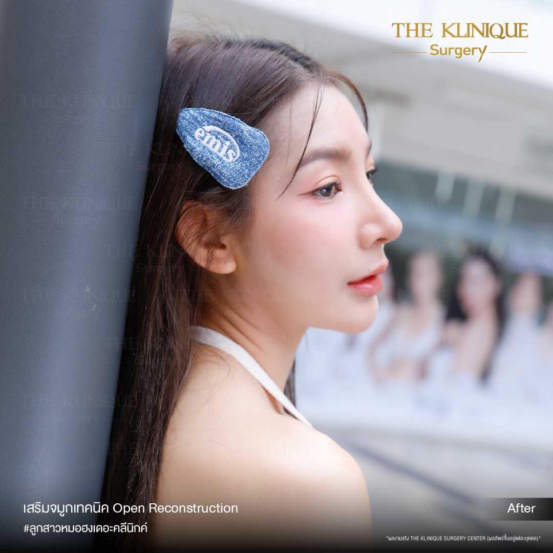 เสริมจมูก, ศัลยกรรมจมูก, ศัลยกรรมจมูก รีวิว, รีวิว เสริมจมูก, ศัลยกรรมจมูกมีกี่แบบ, เสริมจมูกที่ไหนดี, เสริมจมูกโอเพ่น, เสริมจมูกราคา, รีวิวเสริมจมูก, ทำจมูก, ทำจมูก รีวิว, รีวิวทำจมูก, รีวิว ศัลยกรรมจมูก, ซิลิโคนจมูก, แก้จมูก, แก้จมูก รีวิว, รีวิวแก้จมูก, แก้จมูกที่ไหนดี, เสริมจมูก Close, เสริมจมูก semi open, จมูก open, เสริมจมูก Open ที่ไหนดี, รีวิว เสริมจมูก Open, เสริมจมูกโอเพ่น, เสริมจมูกโอเพ่นที่ไหนดี, ทรงจมูก, ทรงจมูกสวย, ทรงจมูกเกาหลี, ทรงจมูกธรรมชาติ, ทรงจมูกสโลปปลายพุ่ง, ทรงจมูกผู้ชาย